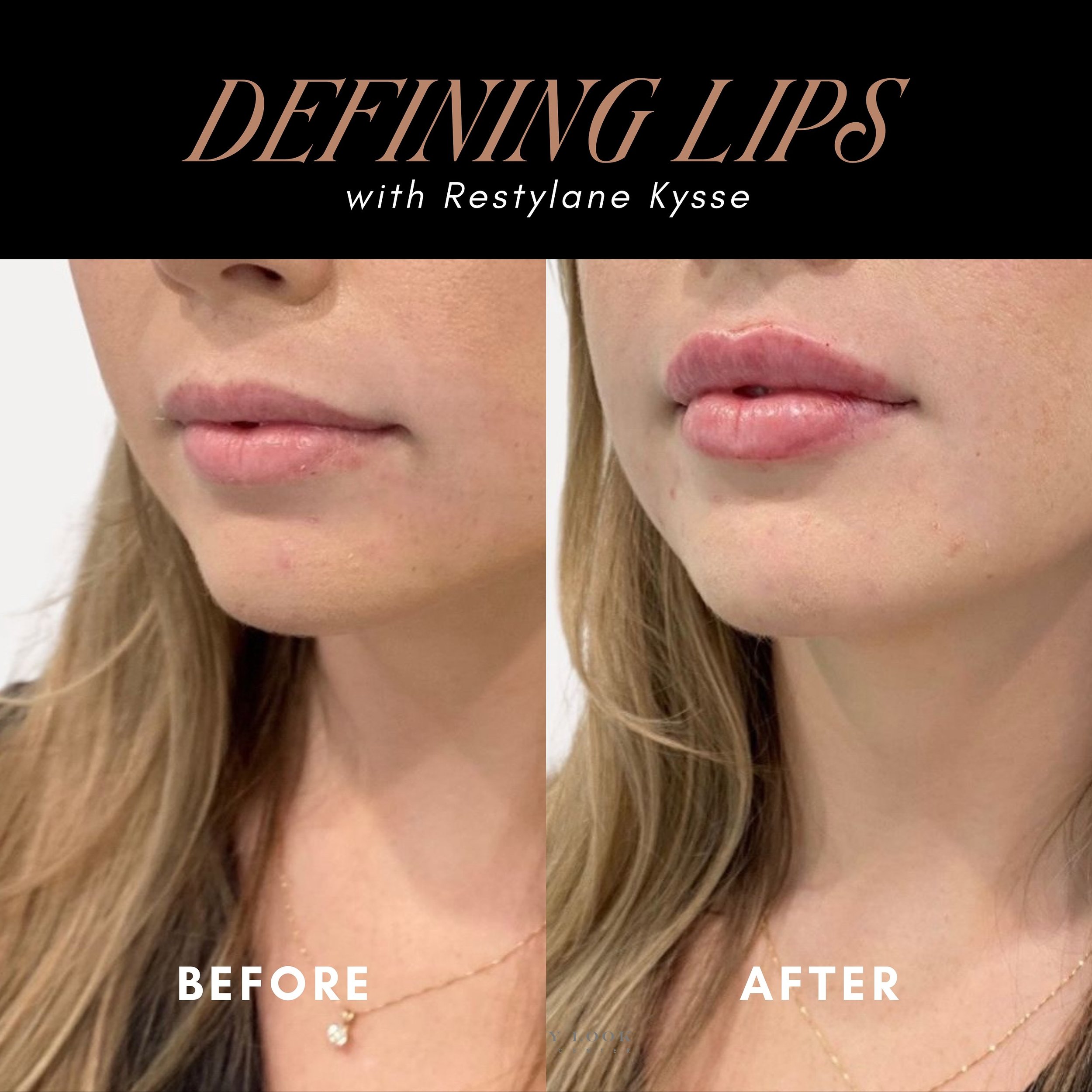 Crafting the perfect pout with precision and care! 💉👄✨ To maintain a natural feel, we chose Restylane Kysse for its subtle enhancement. ✨ Flawlessly perfect lips! 

Services we offer:
▪️ Fillers 
▪️ Anti-aging treatments
▪️ Facial Balancing
▪️ Lase