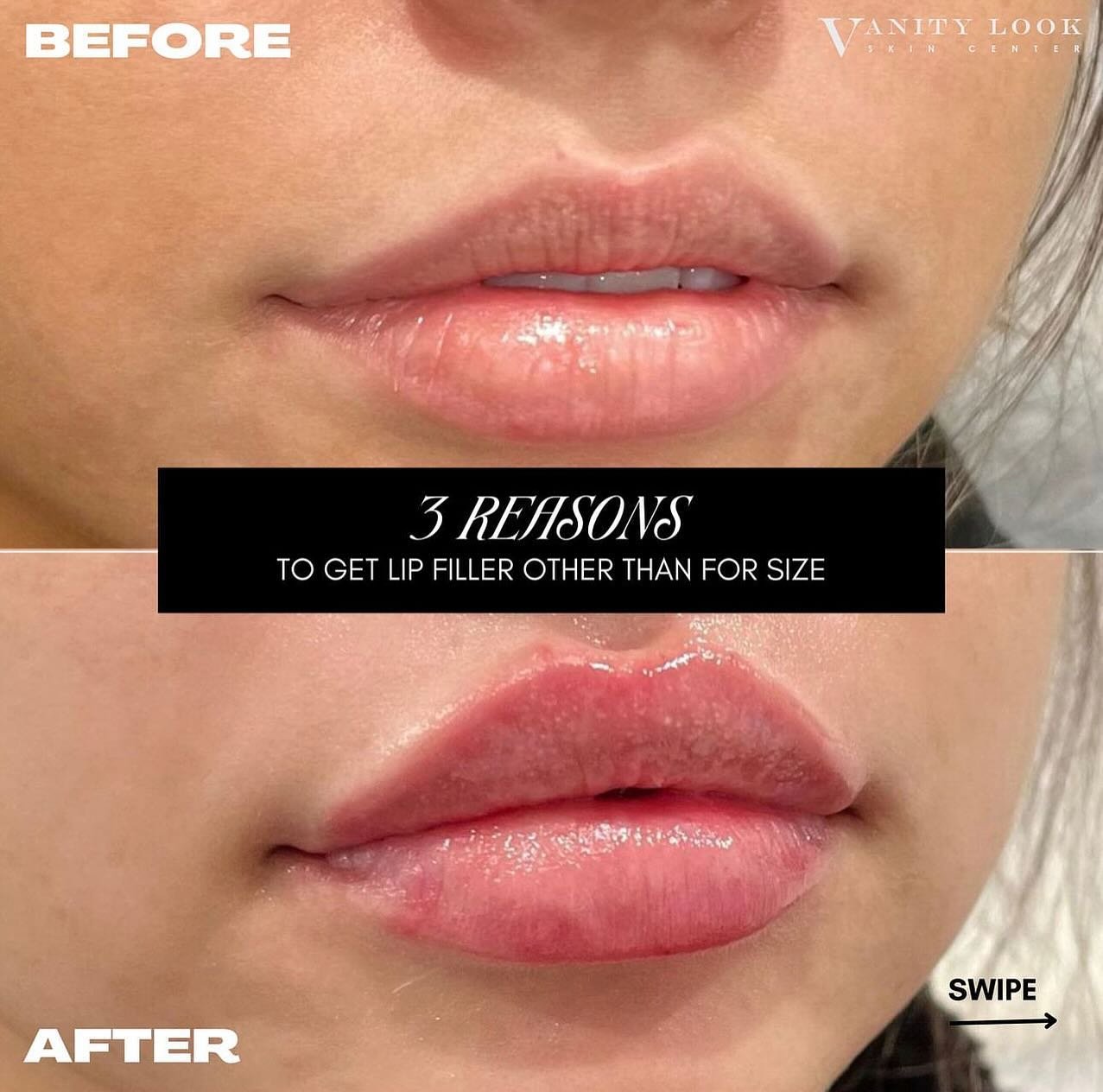SWIPE ➡️ to see 3 reasons to do your lips other than for size! 

#facialbalance #lipfiller #chinfiller #aesthetic #luxury #facialbalancing #skincare #skincareroutine #aestheticinjector #cosmeticinjectables #cosmeticinjector