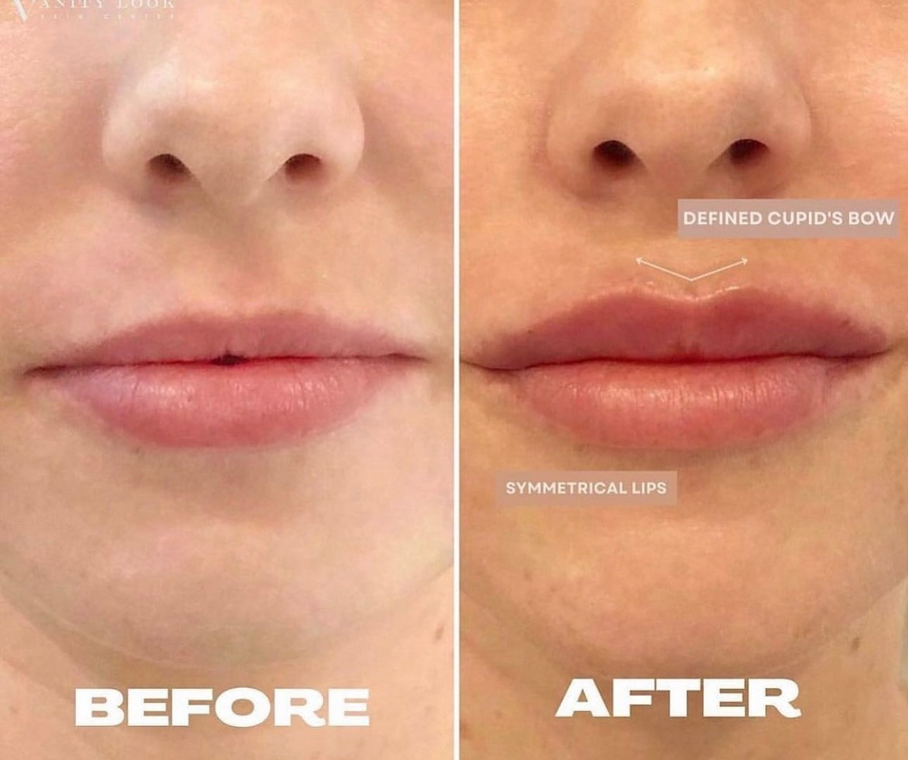 Get the lips you deserve with our $495 lip filler special on a full syringe of Juvederm Ultra XC 👄 For this result, we focused on shaping her lips and defining her Cupid&rsquo;s bow 

Call us at (818) 290-3938 to schedule an appointment!

Services w