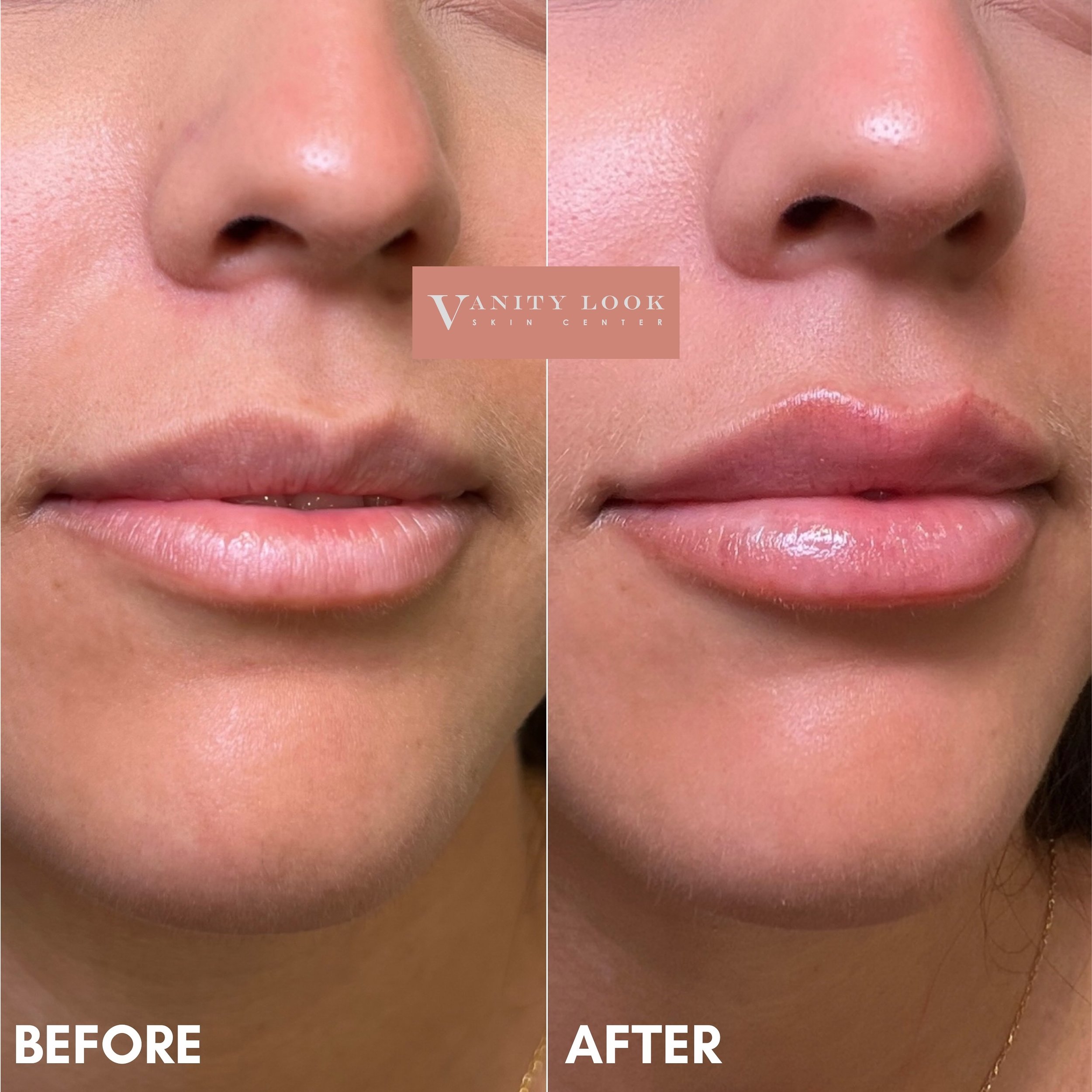 Pouty, hydrated, and defined 💉👄✨ We achieved lip height, definition, and hydration with this lip filler result 💋

Services we offer:
▪️ Fillers
▪️ Botox &amp; Dysport
▪️ Facial Balancing
▪️ Laser Hair Removal
▪️ Skin Rejuvenation
▪️ Morpheus8 for 