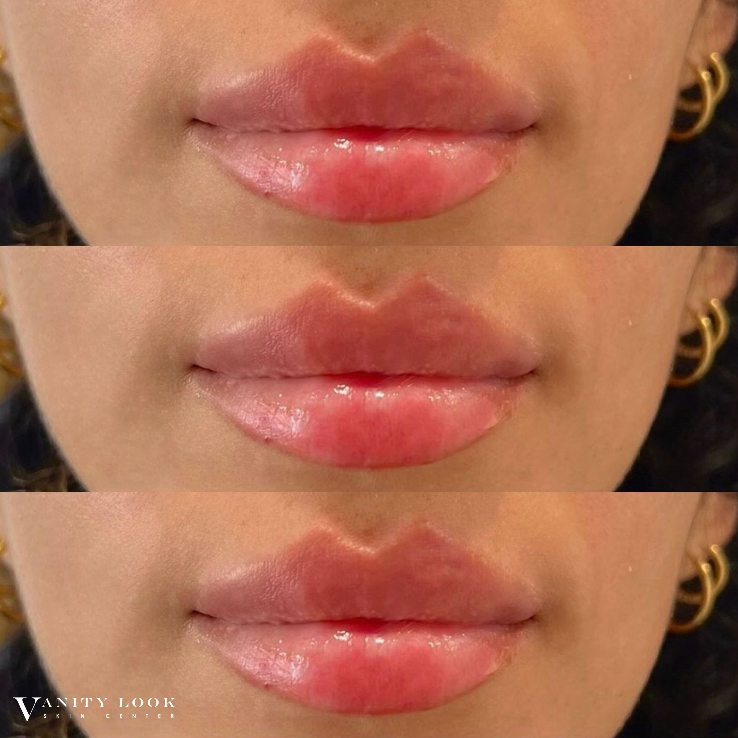 This lip shape! 💉👄 Double tap if you love it! 💕

Services we offer:
▪️ Fillers 
▪️ Anti-aging treatments
▪️ Facial Balancing
▪️ Laser Hair Removal
▪️ Skin Rejuvenation
▪️ Morpheus8 for face and body
▪️ PRX Derm Perfexion
▪️ Aquagold
▪️ SkinVive
▪️
