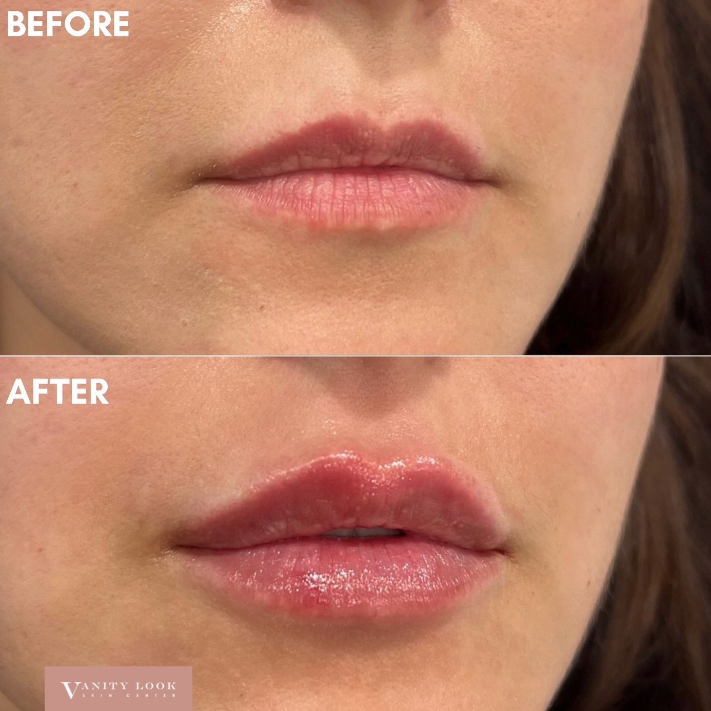 Natural-looking lip filler result 💉👄✨ We achieved lip height, definition, and hydration with this result 💋

Services we offer:
▪️ Fillers
▪️ Botox &amp; Dysport
▪️ Facial Balancing
▪️ Laser Hair Removal
▪️ Skin Rejuvenation
▪️ Morpheus8 for face a