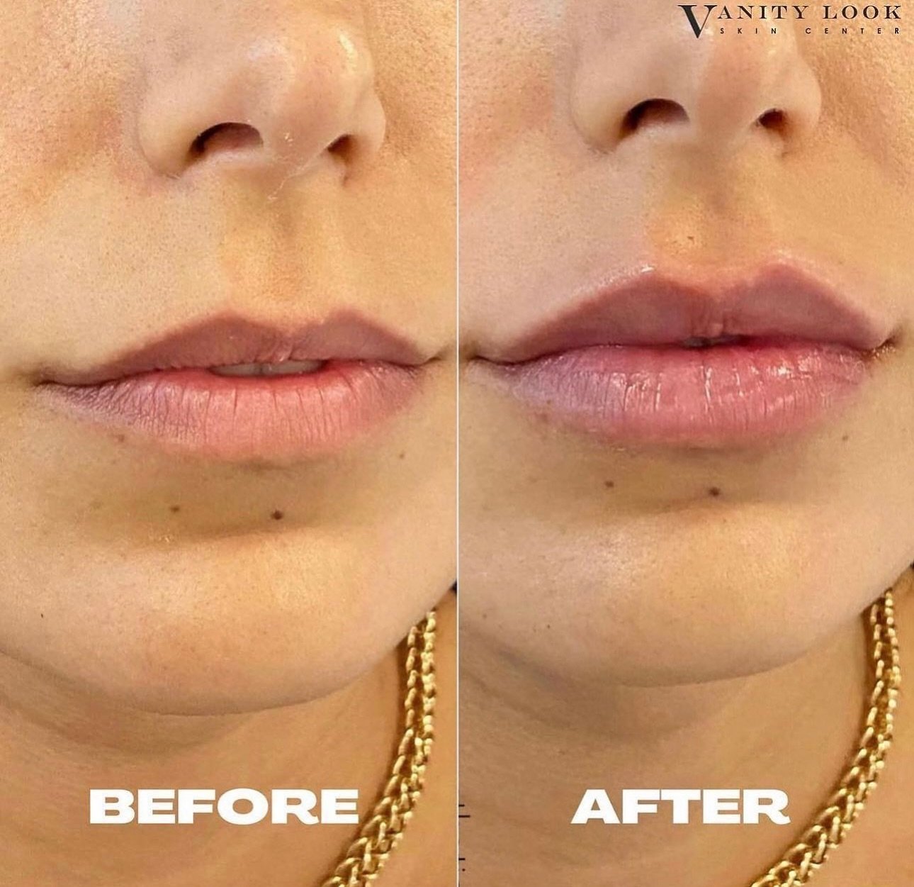 KYSSE lips! 👄 A subtle plump with border definition using Restyle Kysse. 

Call us at (818) 290-3938 to schedule an appointment!

#antiwrinkle #browlift #facelift #hyaluronicacid #lipfillers #dermalfiller #nonsurgical #lipaugmentation #dysport #lipe