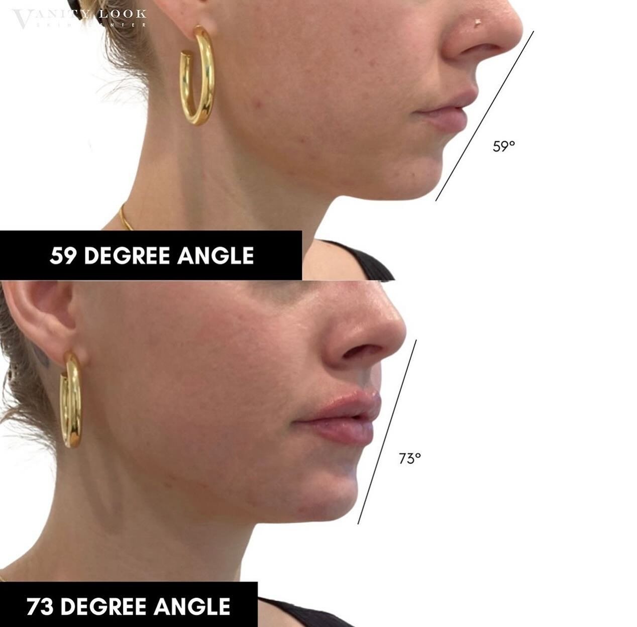 Evaluating the chin is a critical aspect of assessing facial balance and symmetry. Here are six ways to analyze a chin for a harmonious facial structure:

Width: The width of the chin should complement the width of the forehead and cheekbones to crea