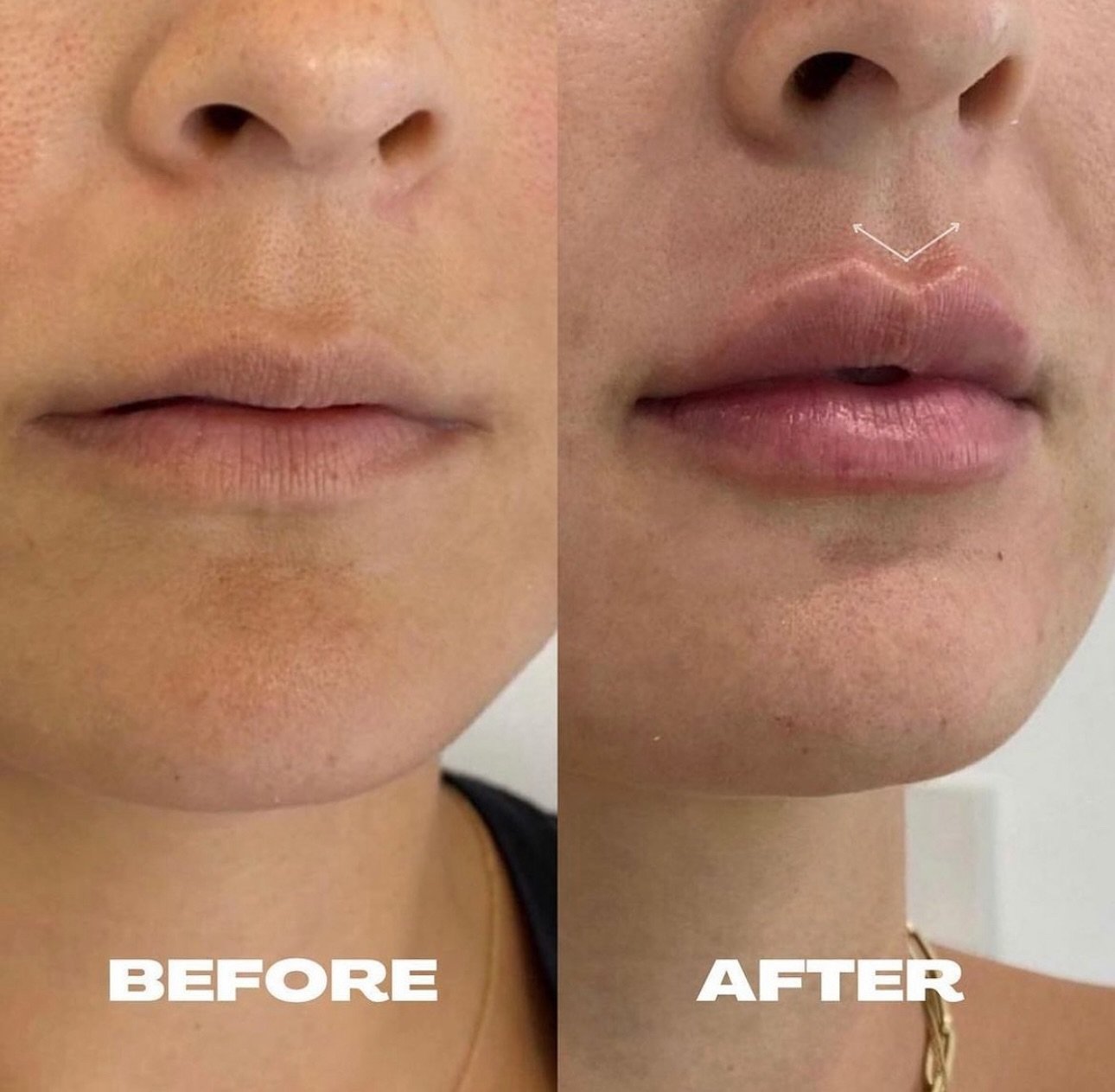 Some experts say that a defined Cupid&rsquo;s bow is the most attractive feature on the face. What do you think? 👄⬇️

Call us tat (818) 290-3938 to schedule an appointment!

Services we offer:
▪️ Fillers 
▪️ Anti-aging treatments
▪️ Facial Balancing