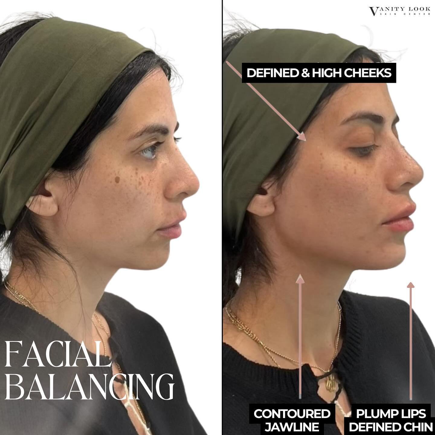 Transforming beauty with FACIAL BALANCING ✨ We enhanced natural contours using 6 syringes across cheeks, chin, and lips for a stunning yet subtle lift. Swipe to see how you can save $75 on this treatment! 

Services we offer:
▪️ Fillers 
▪️ Anti-agin