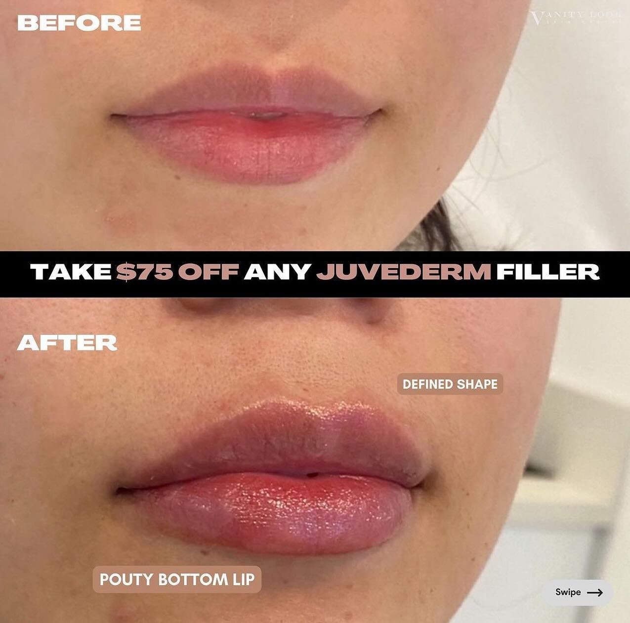 PLUMP PERFECTION 💉👄 Head to the link in our bio to add your $75 off to your Allē wallet. 

Services we offer:
▪️ Fillers 
▪️ Anti-aging treatments
▪️ Facial Balancing
▪️ Laser Hair Removal
▪️ Skin Rejuvenation
▪️ Morpheus8 for face and body
▪️ PRX 