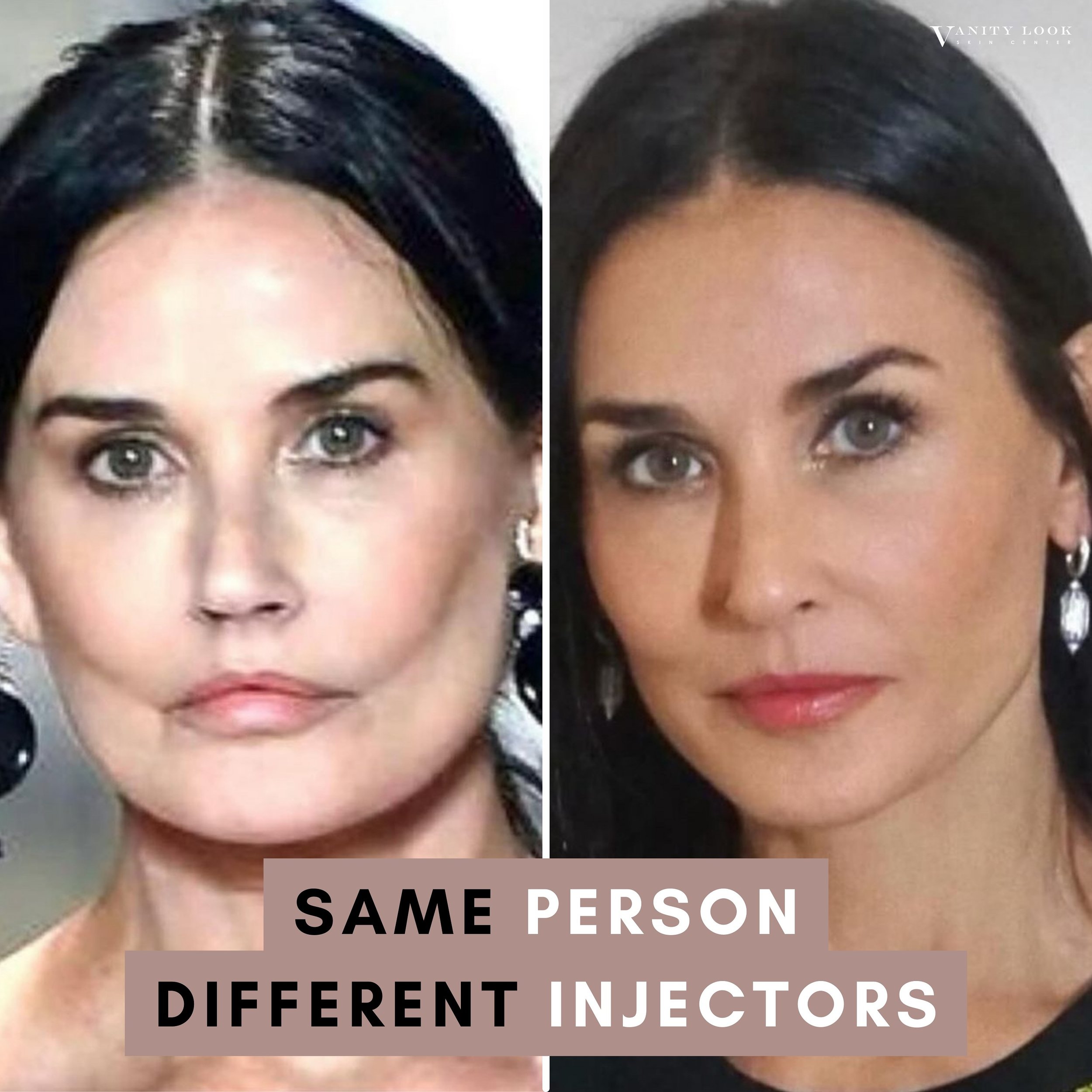 Same PERSON | Different INJECTORS! 💉👄 This is the importance of having an injector that tell you the truth and won&rsquo;t overdo it!

Services we offer:
▪️ Fillers
▪️ Anti-aging treatments
▪️ Facial Balancing
▪️ Laser Hair Removal
▪️ Skin Rejuvena