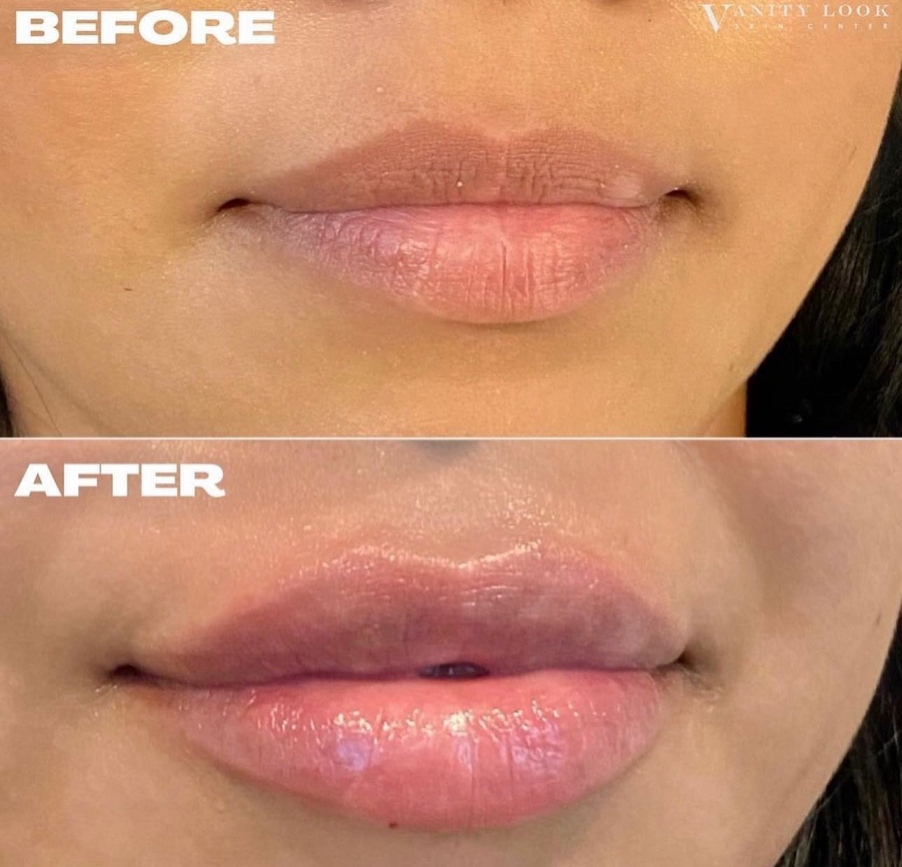Fresh off the needle 👄 We plumped, defined, and balanced our clients lips, leaving her with a natural result.

Contact us to schedule
📞 818-290-3938
📍 13619 Moorpark St, Sherman Oaks, CA 91423
💻 Vanitylookskincenter.com

#lips #lipfiller #filler 