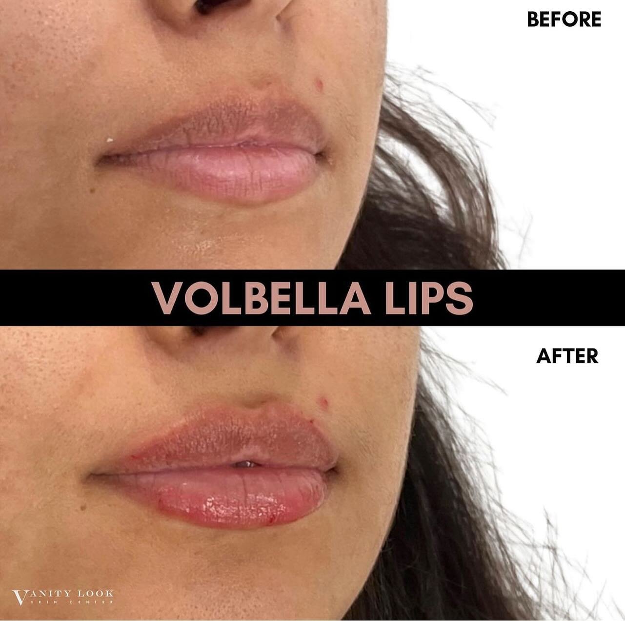 VOLBELLA LIPS! Enjoy $75 off on any product from the JUV Collection of Fillers. Exclusive for both new and returning Allē Members. ✨Head to the link in my stories for the discount

#juvederm #modaesthetica #skincare #skincareroutine #lipfiller #fille