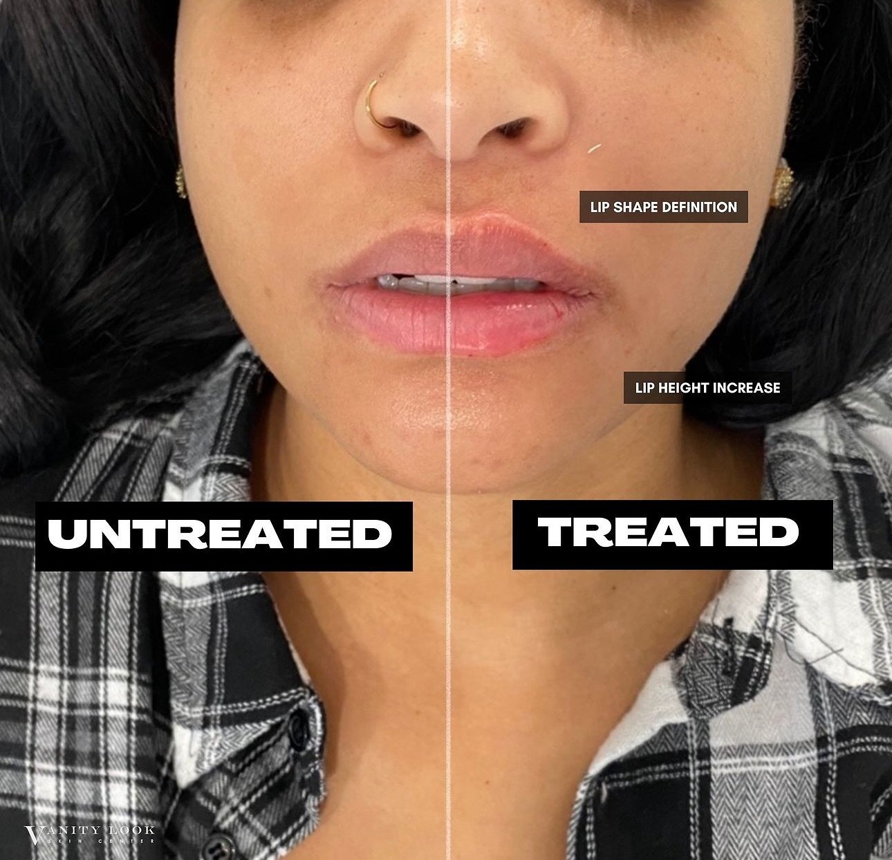 Can lip filler really make a difference? Here&rsquo;s a side-by-side comparison of treated vs. untreated lips 💉👄

Services we offer:
▪️ Fillers 
▪️ Anti-aging treatments
▪️ Facial Balancing
▪️ Laser Hair Removal
▪️ Skin Rejuvenation
▪️ Morpheus8 fo