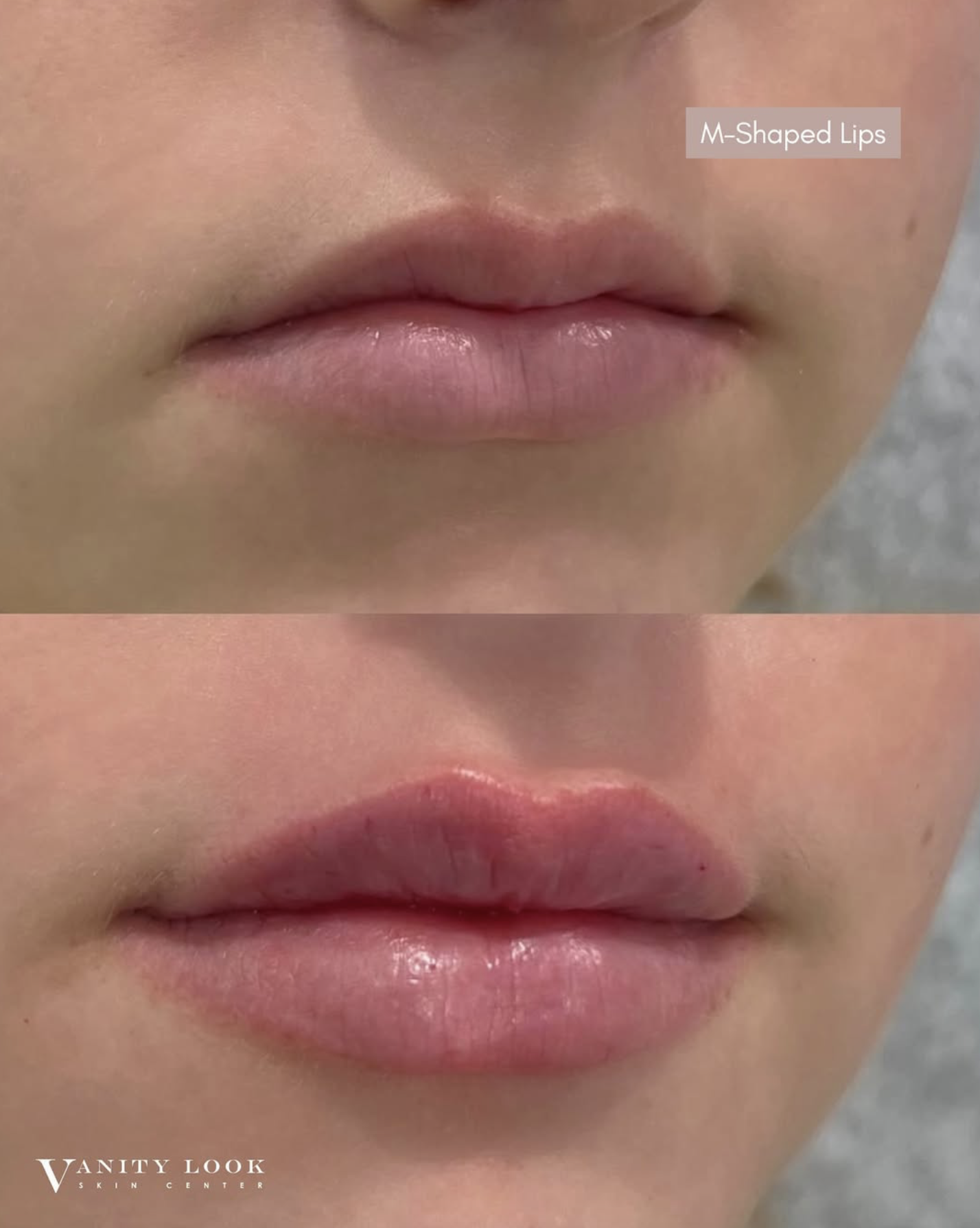 How to Know If You Have M-Shaped Lips