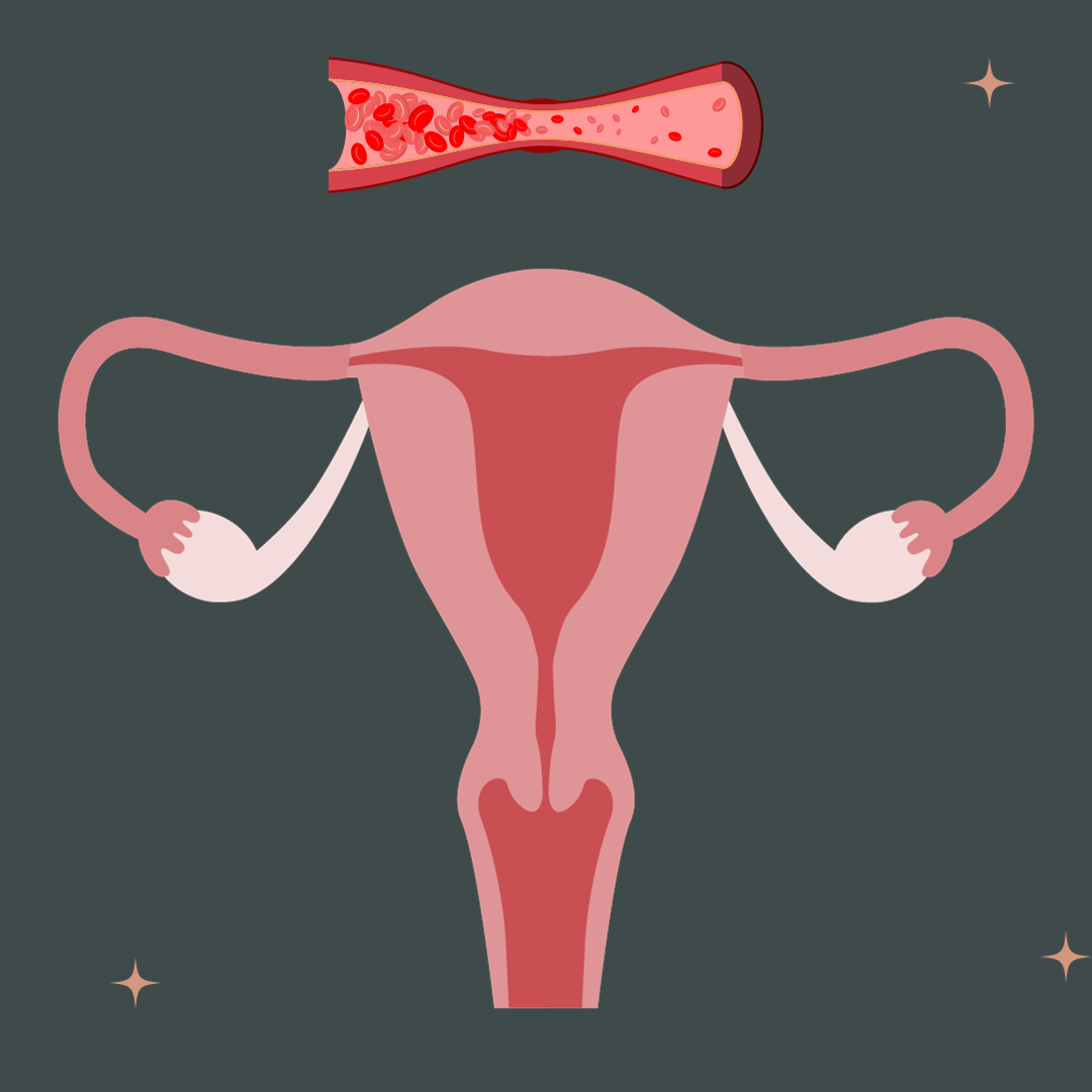 Pelvic Congestion Syndrome: Symptoms, Treatment, and Connection to Fibroids