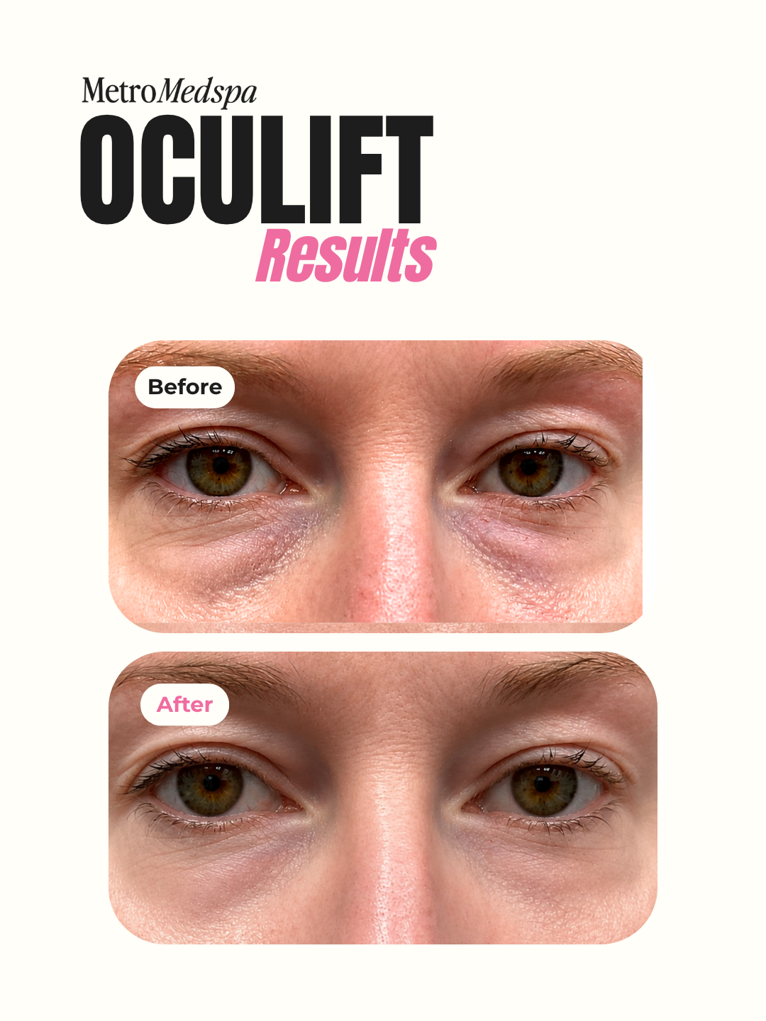 Metro - BA OCULIFT.png