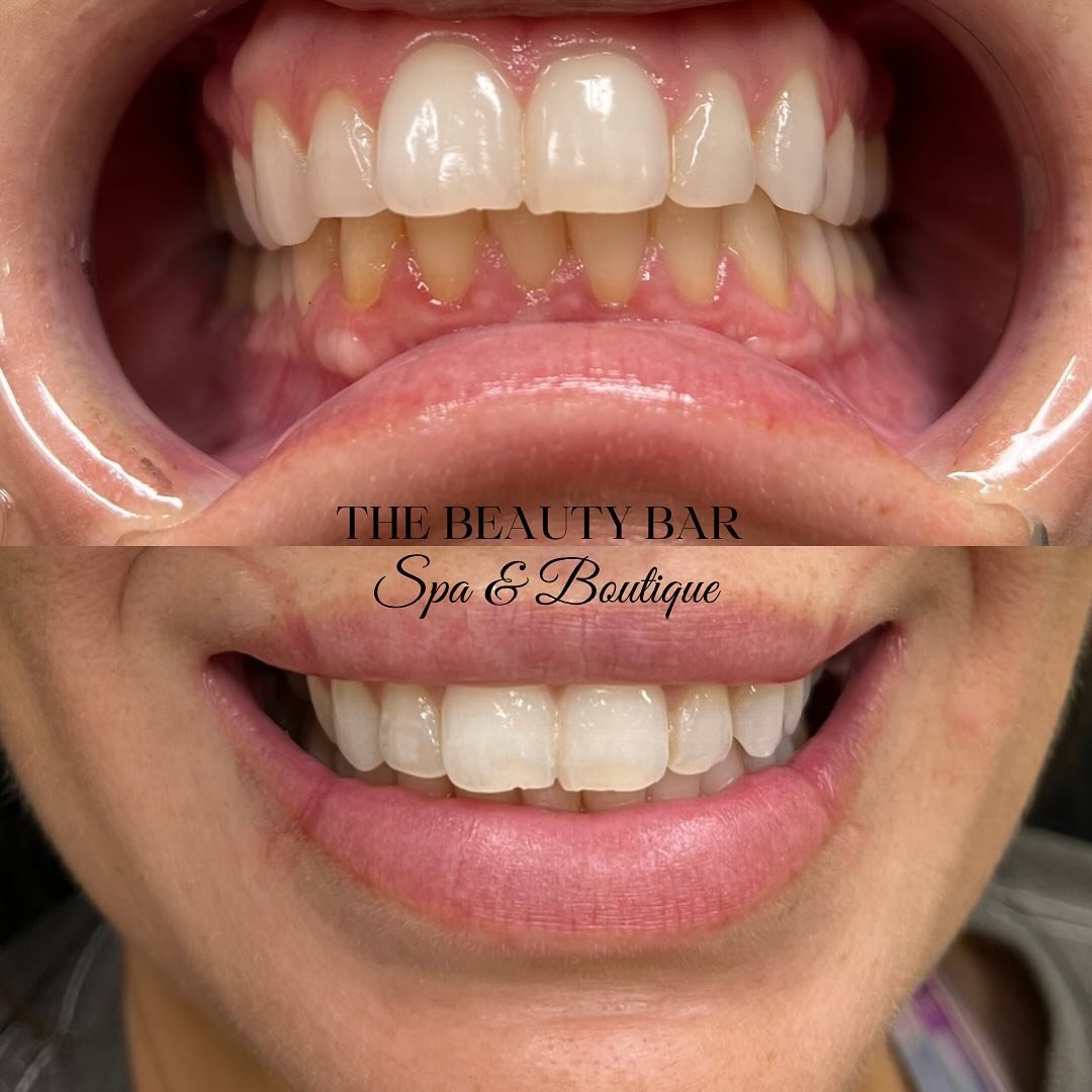 You smile a lot bigger when you&rsquo;re confident in your smile!!☺️

🦷30 minute session - $50
🦷1 hour session - $100 

💎Ready to make the step in brightening your smile?
Book using the 🔗 in our bio or give us a call 225-480-9099📞 
 #teethwhiten