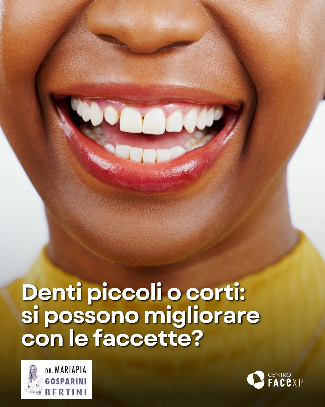 La risposta è sì!🤔

Questa condizione, definita microdonzia, è generalmente causata da fattori genetici o dall'usura e dalle fratture che interessano la parte visibile dei denti.

La microdonzia non si manifesta sempre nello stesso modo e, infatt