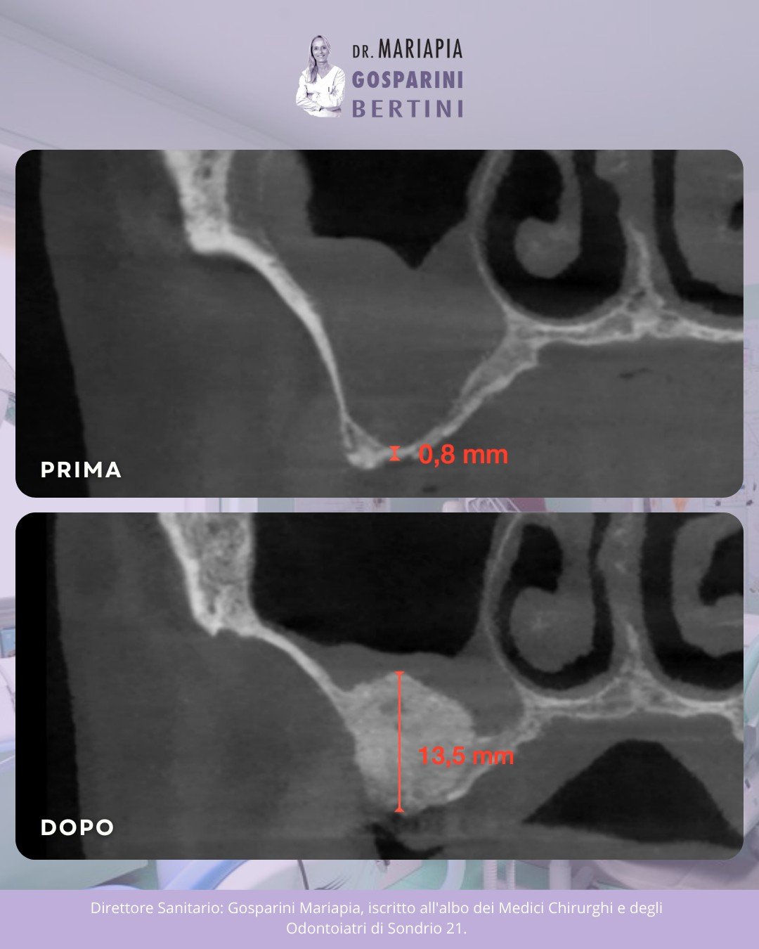 Vuoi un impianto dentale ma ti hanno detto che non hai abbastanza osso? 🦷❌

Se l&rsquo;osso nella parte posteriore del mascellare superiore &egrave; insufficiente, niente paura: grazie al rialzo del seno mascellare possiamo rigenerare l&rsquo;osso n