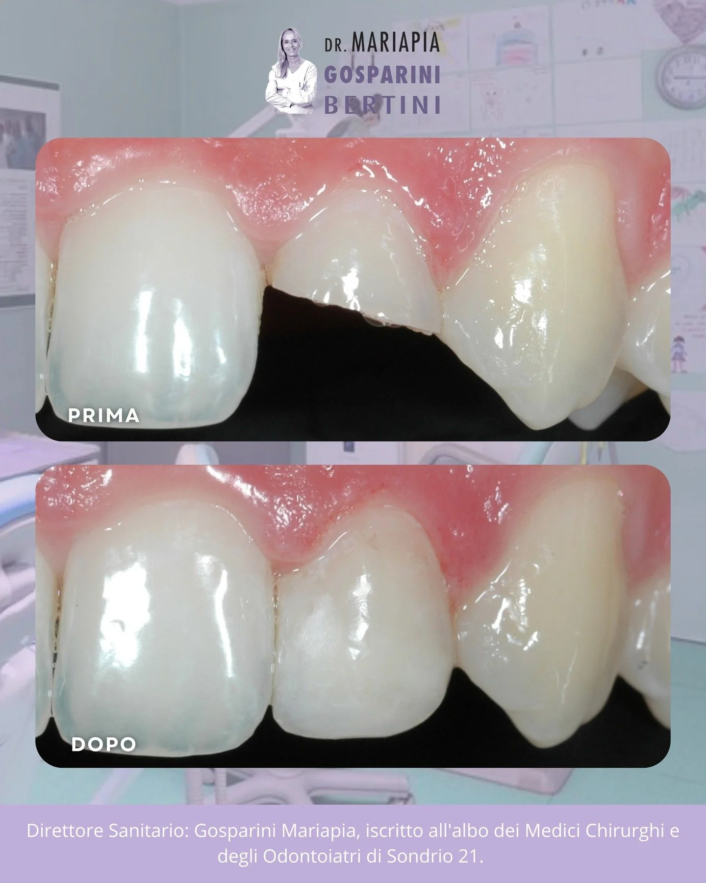 ✨ FRATTURA DENTALE TRAUMATICA
In questo caso il trauma &egrave; dovuto a una gomitata durante una partita di basket. Per fortuna il frammento &egrave; stato ritrovato e conservato correttamente: questo ci ha permesso di riattaccarlo con un risultato 