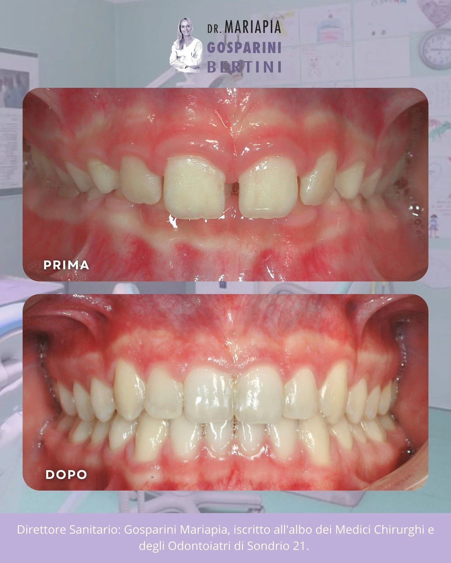 ✨ Un nuovo sorriso, pi&ugrave; armonico e funzionale
In questo caso abbiamo:
👉 corretto ortodonticamente il morso profondo,
👉 chiuso gli spazi tra i denti,
👉 realizzato piccole ricostruzioni estetiche per armonizzare le proporzioni del sorriso.

I