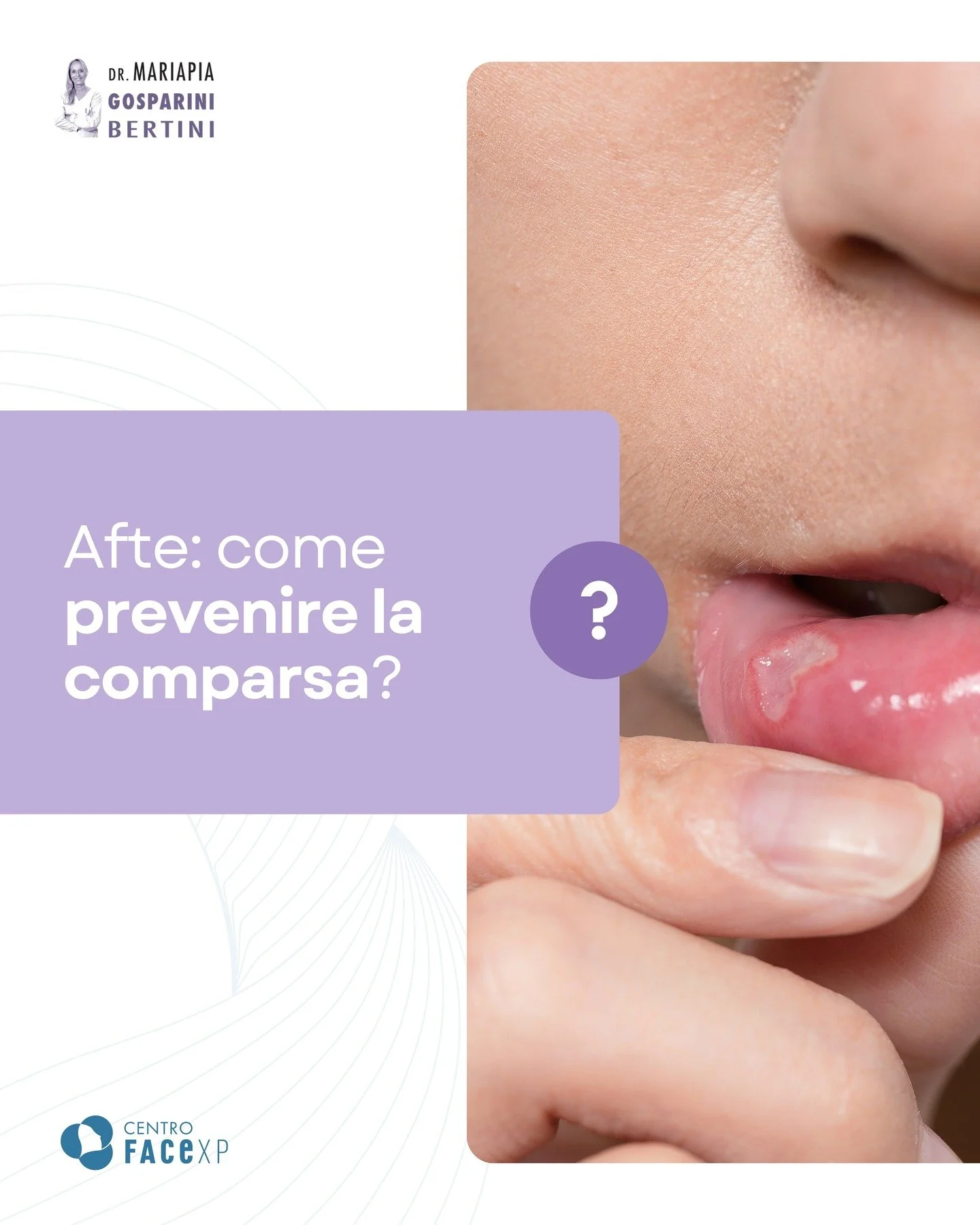 Lo sapevi che lo stress psicofisico &egrave; tra le cause principali della formazione delle afte? 🤯
Piccole ma fastidiose, le afte possono provocare arrossamento, gonfiore e dolore, anche intenso&hellip; e
rovinarti i giorni di relax!

👉 La buona n