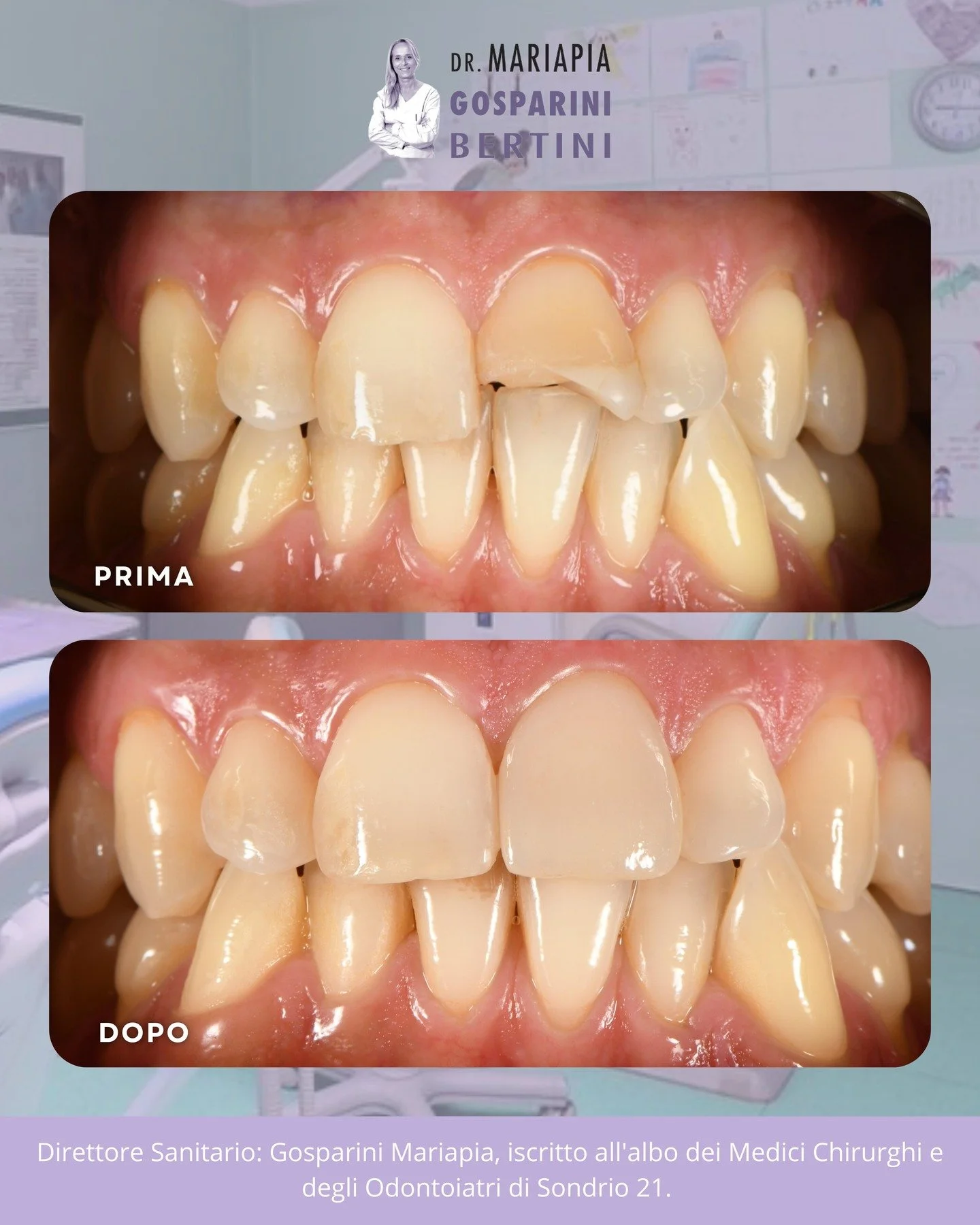 ✨ Dal restauro alla ceramica: un nuovo sorriso
Questo incisivo era stato ricostruito con una otturazione circa 15 anni fa. Dopo un nuovo trauma, la ricostruzione ha ceduto: per garantire un risultato pi&ugrave; predicibile, duraturo e altamente estet