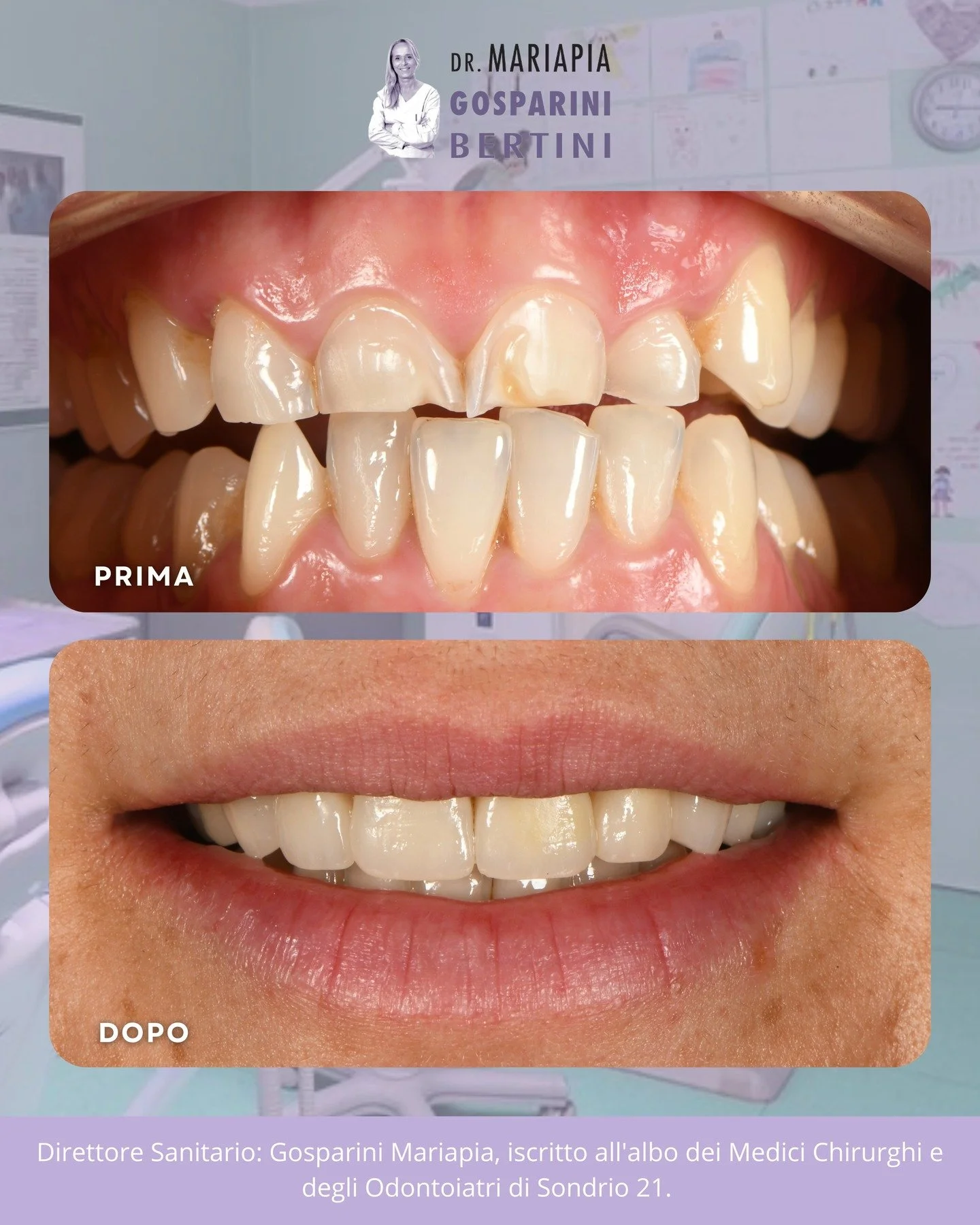 ✨ PRIMA / DOPO

Una giovane paziente presentava una marcata erosione dello smalto degli elementi anteriori e un&rsquo;importante usura dei margini incisali.
Il bruxismo e l&rsquo;affollamento dentale avevano progressivamente compromesso l&rsquo;equil