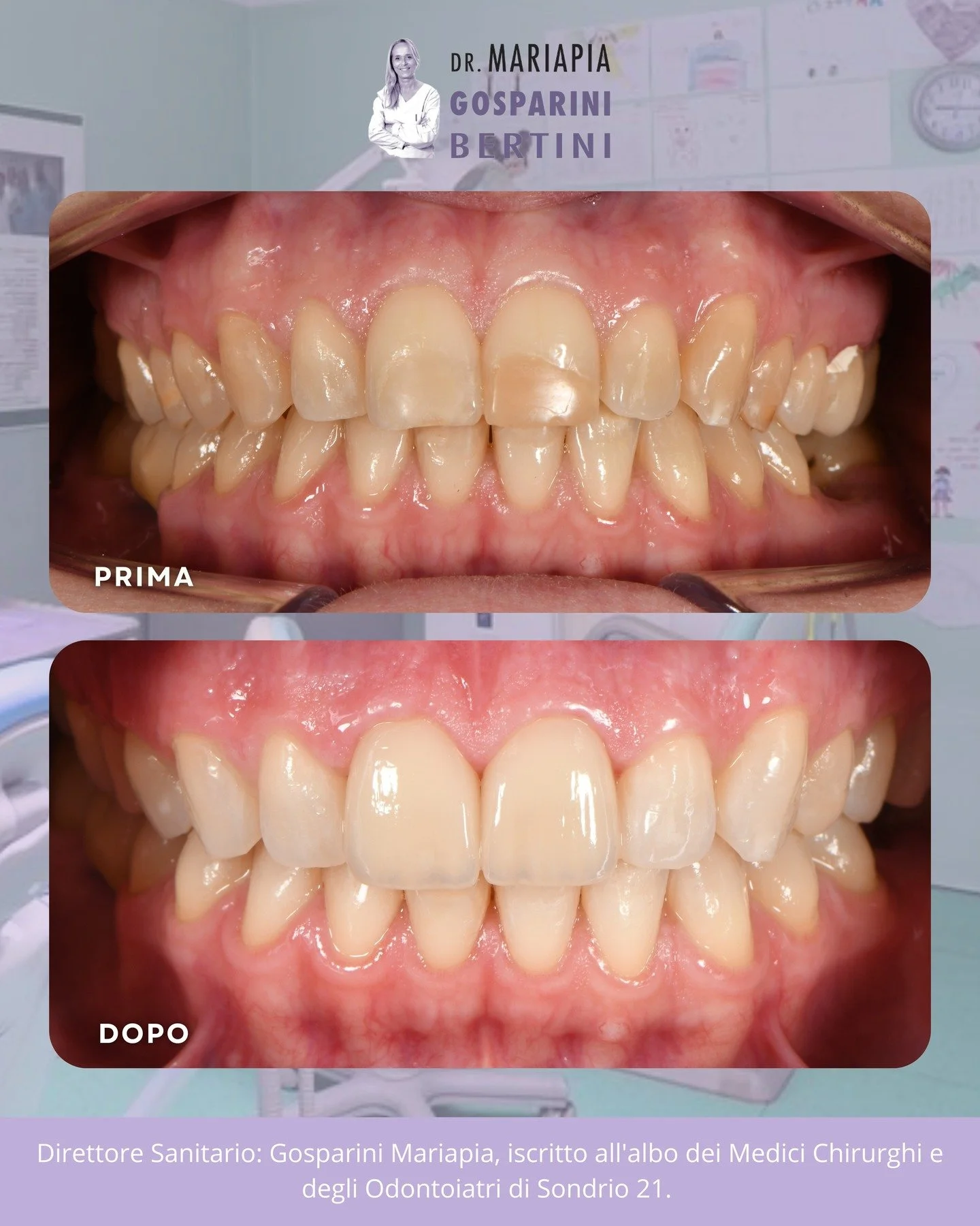 A volte bastano interventi mirati per migliorare in modo significativo estetica e funzione del sorriso.

In questo caso abbiamo ottenuto un risultato pi&ugrave; armonioso grazie a:
✨ sbiancamento dentale professionale
✨ 2 faccette in ceramica sugli i