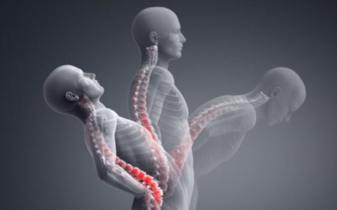 What is Spinal stenosis?