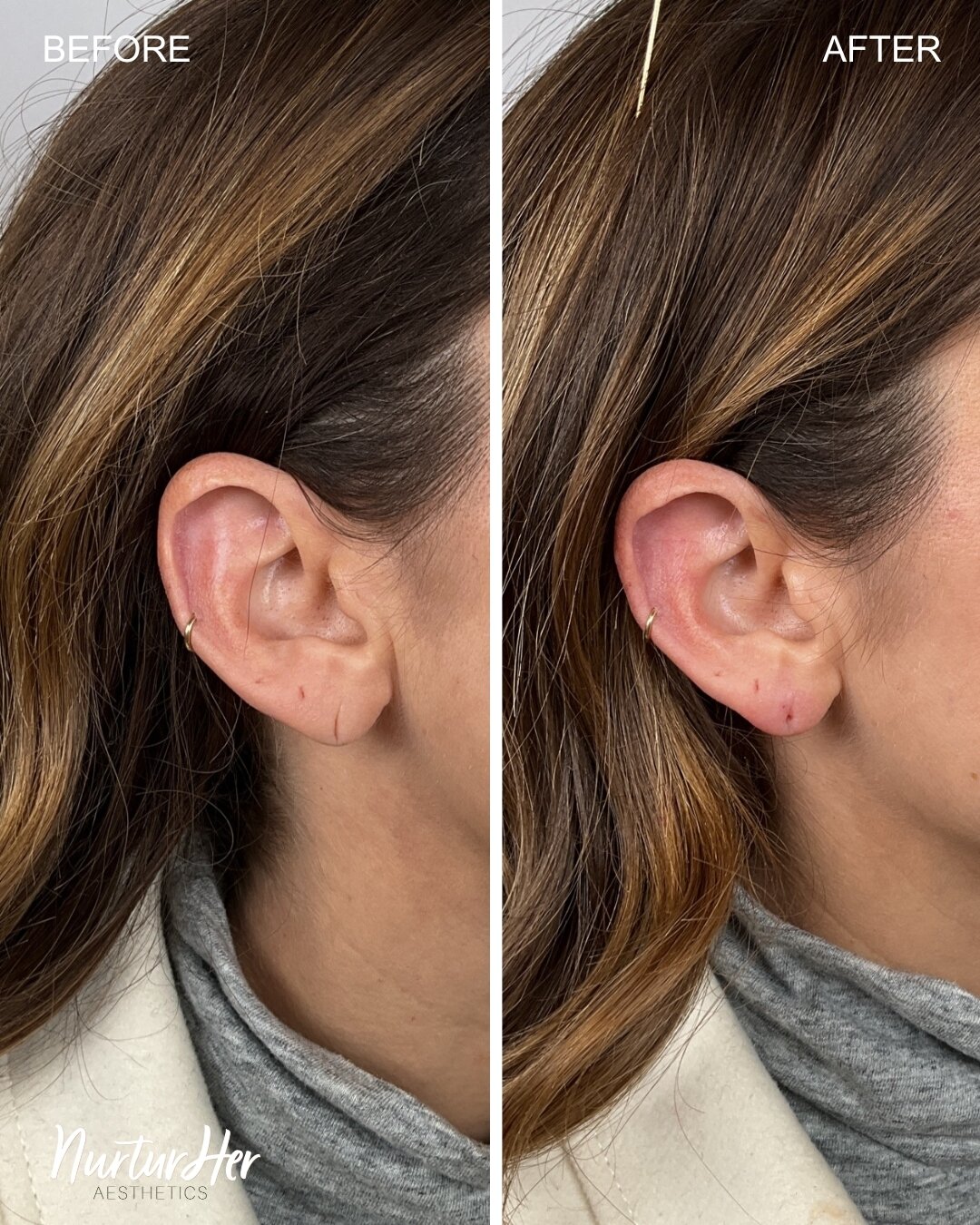 BEFORE AND AFTER⁣⁣Treatment: Earlobe filler
Purpose: Reshape and correct stretched earlobe tissue
Treatment time: 30 minutes
Anesthesia: NA
Downtime: Potential swelling and bruising for a few days

BOOK WITH US 👇🏼
📍#MadisonWI #Sunprairie
📧 nurtur
