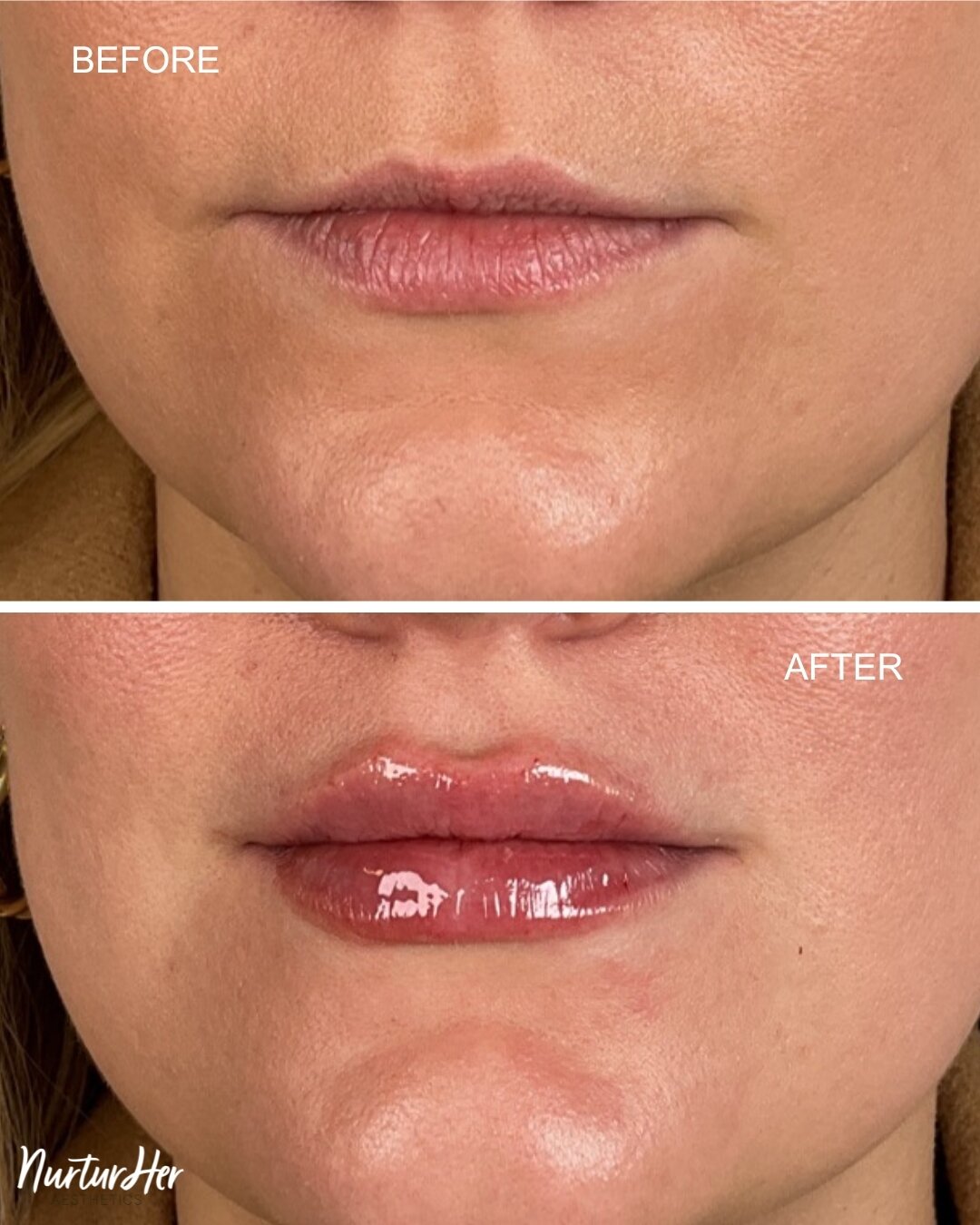 BEFORE AND AFTER⁣⁣Treatment: 1/2 Syringe Lip Filler 
Purpose: hydration and subtle plump
Treatment time: 30 minutes
Anesthesia: Topical numbing
Downtime: Expect swelling for 2-3 days, bruising for approximately 1 week, lumps/bumps up to 4 weeks. 

BO