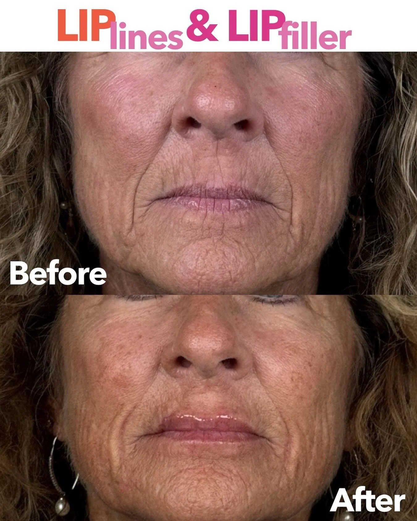 LIP lines ➡️ LIP filler ➡️ LIP magic💋

Softening those vertical lip lines and restoring volume in a subtle, natural-looking way is what we do best.

This transformation? Chef&rsquo;s kiss 👩&zwj;🍳💉