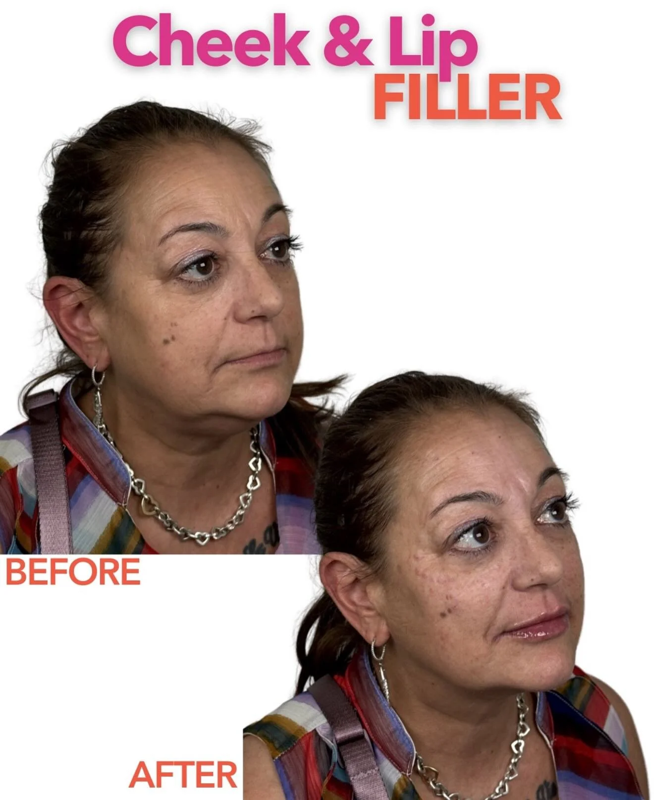 Subtle. Elevated. Confident ✨

This beautiful transformation shows how cheek + lip filler can enhance natural features, restore balance, and create soft, timeless definition. The goal isn&rsquo;t to change your face, it&rsquo;s to highlight what alre