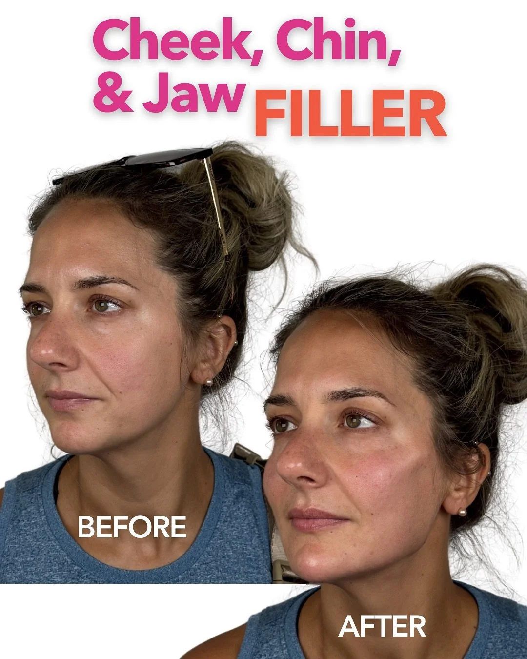 The power of profile perfection ✨

Swipe to see how just a few syringes can:
✔️ Add structure
✔️ Enhance symmetry
✔️ Define your angles without makeup

Ready for your after? Let&rsquo;s sculpt!

BOOK WITH US 👇🏼 📍#MadisonWI #SunPrairieWI 📧 nurturh