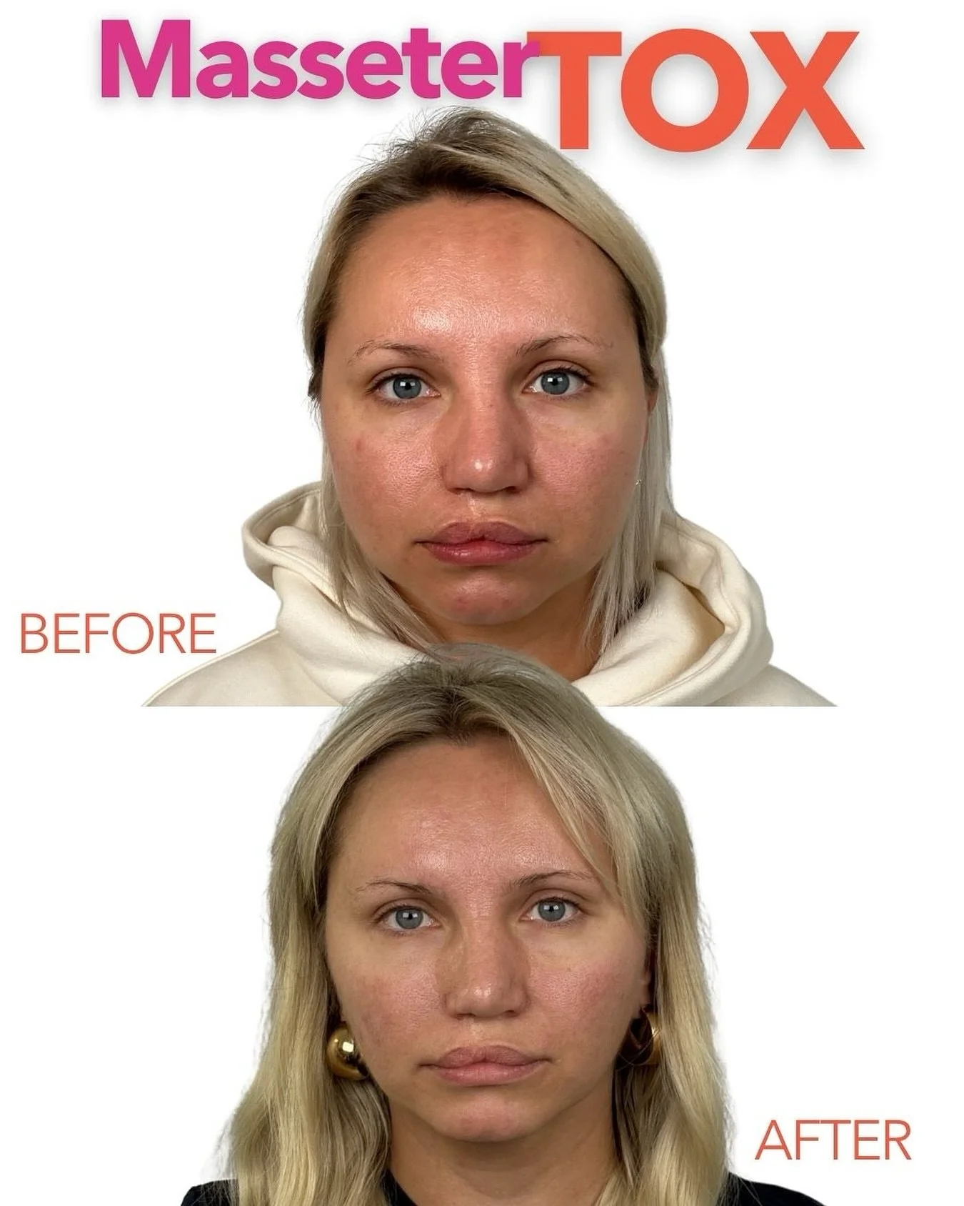 Masseter Tox isn&rsquo;t just a trending treatment, it&rsquo;s a full-on face changer 💗✨

If you:
&ndash; Clench your jaw constantly
&ndash; Struggle with TMJ or tension headaches
&ndash; Grind your teeth in your sleep
&ndash; Want to slim a square 
