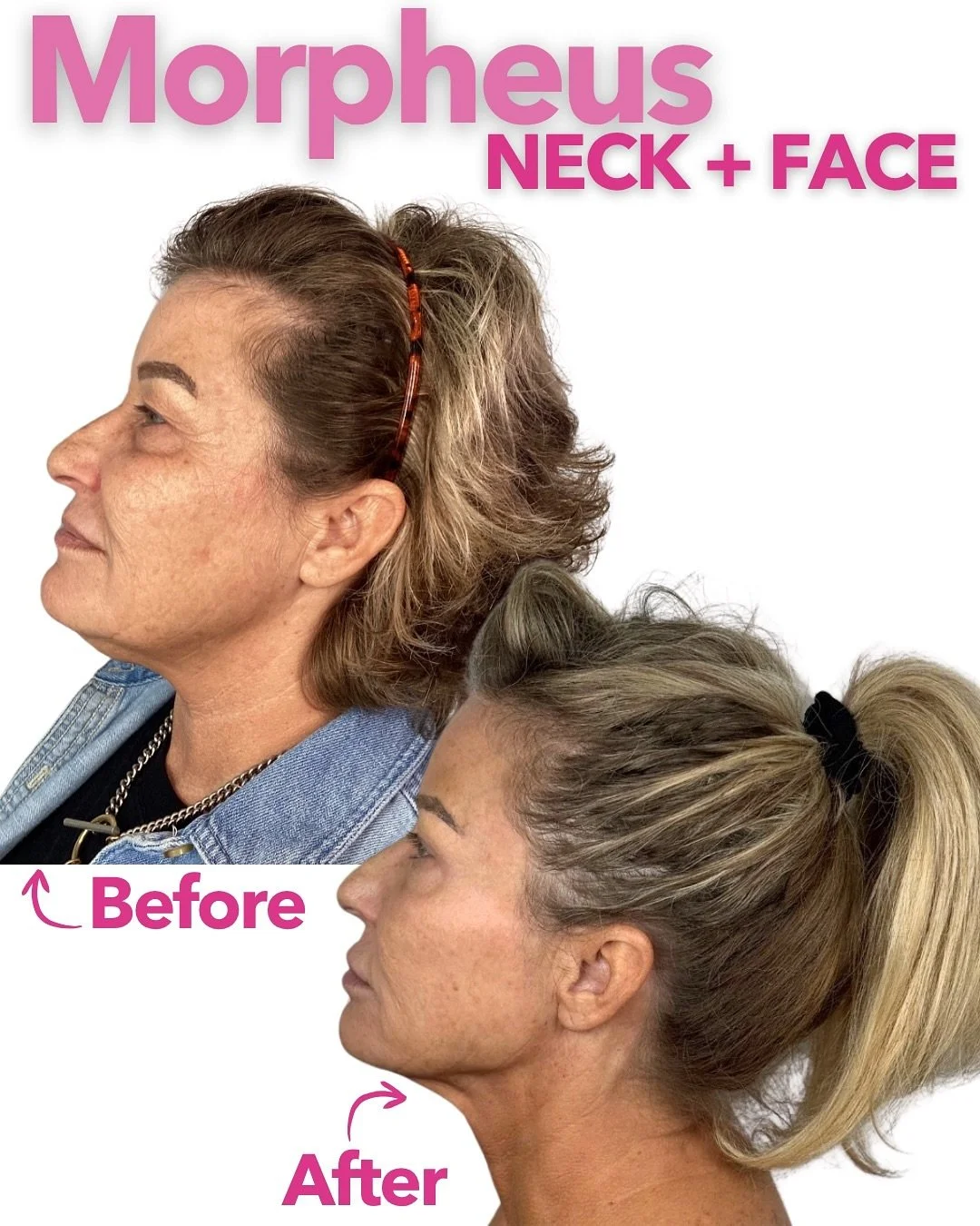 ✨ Sculpted. Snatched. Smoothed.

This Morpheus8 before &amp; after is next level 🙌🏼

We&rsquo;re talking:
✔️ Tighter jawline
✔️ Lifted lower face
✔️ Defined neck contour
✔️ Firmer, smoother skin texture

Just Morpheus8 doing what it does best: stim