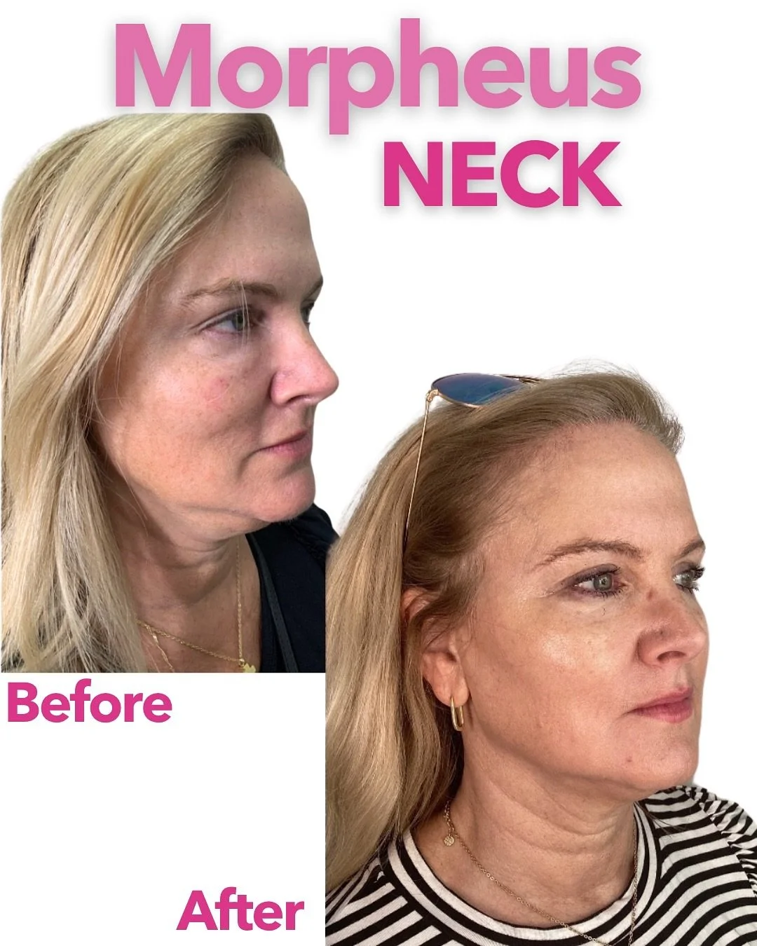✨ The kind of results that speak for themselves&hellip;
This is your sign to stop scrolling and start sculpting 💉💥

Morpheus8 isn&rsquo;t just another skin treatment&mdash;it&rsquo;s a full-face (and neck!) rejuvenation that works from the deepest 