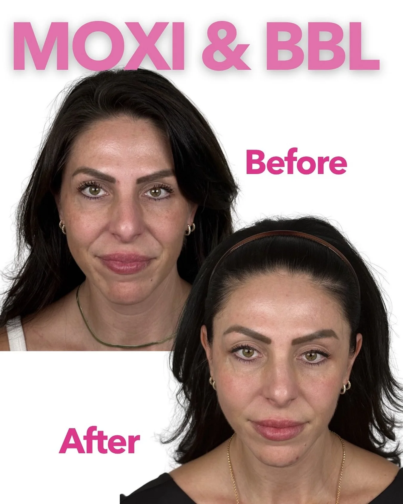 MOXI + BBL = Skin magic, unlocked 🔐

This before &amp; after is your reminder that real results do exist and they start with the power of combination therapy.

✨ MOXI targets texture + early signs of aging 
⚡️ BBL corrects pigment, redness + sun dam