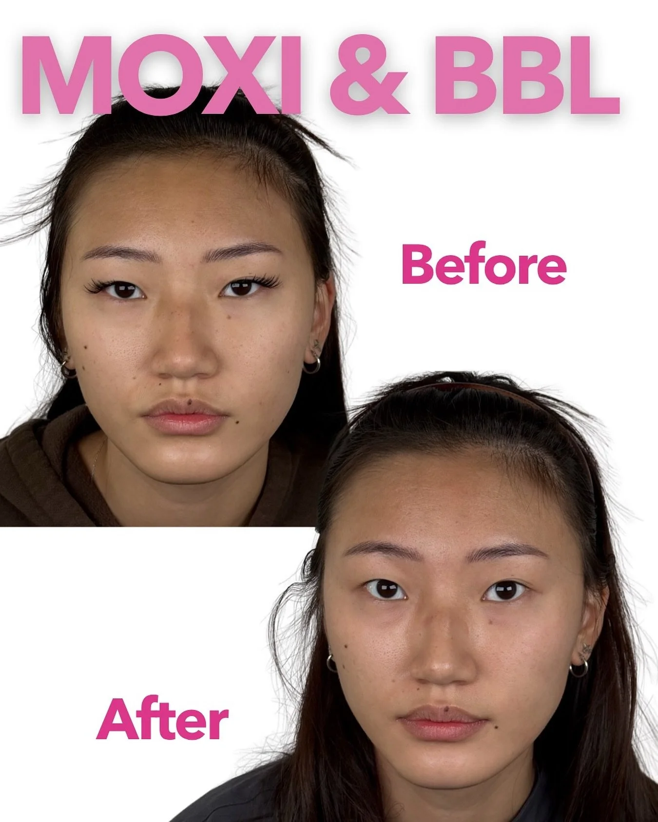 MOXI &amp; BBL ✨ Your new favorite skin duo

If you&rsquo;re going for brighter, clearer, smoother skin &mdash; this combo is that girl. MOXI gently resets tone and texture, while BBL clears pigment, redness, and sun damage. 

And the beauty of it? M