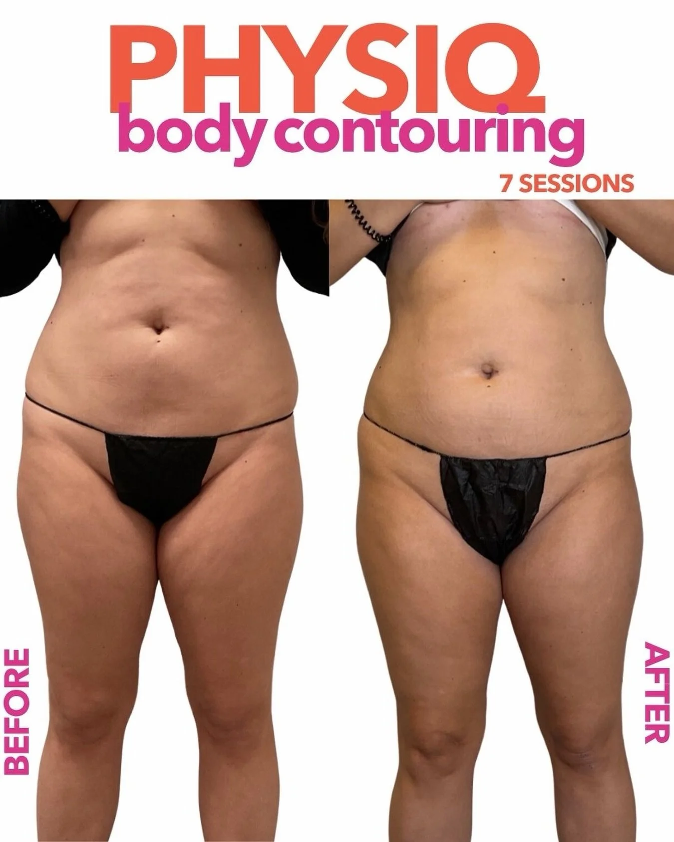 Okayyy Physiq is physiq-ing 😮&zwj;💨✨

This before + after is after 7 sessions and it&rsquo;s the perfect example of why we love Physiq body contouring. 

Physiq uses heat-based technology to help target stubborn areas and support a smoother, more s