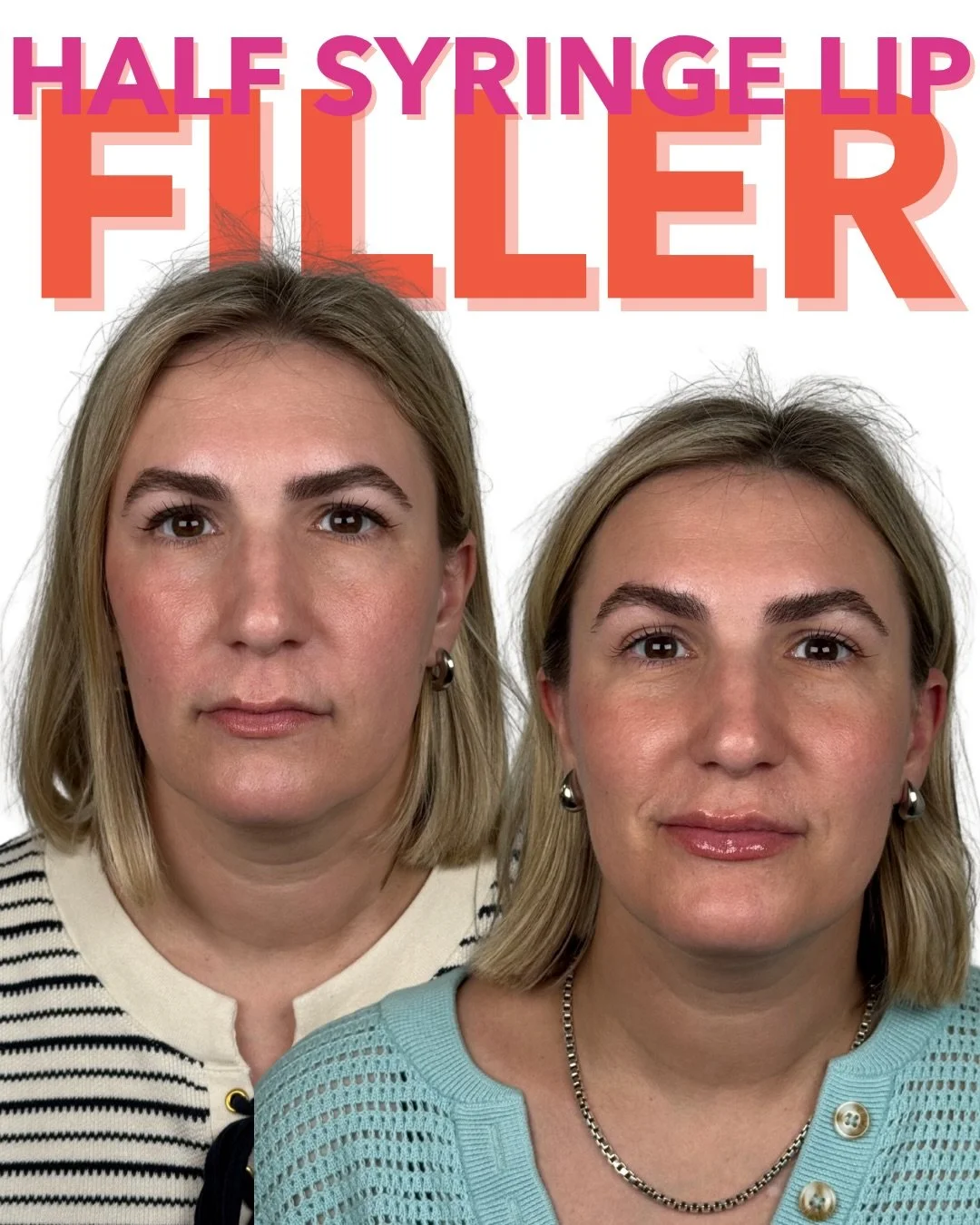 Proof that lip filler doesn&rsquo;t have to look like &ldquo;lip filler&rdquo; 

A half syringe can be all it takes to refine the shape, restore subtle volume, and create a soft, hydrated finish without overwhelming your natural features.

Consider t