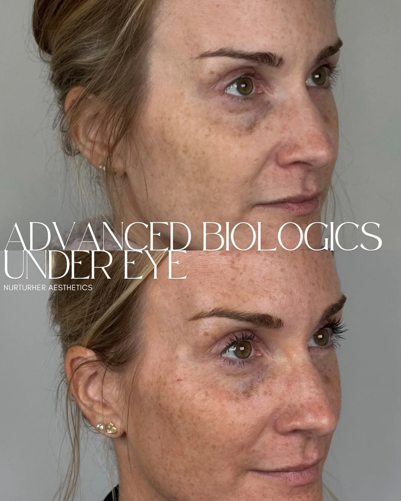 A different approach to the under eye.

When the goal is refreshed, not filled, advanced biologics offer a more regenerative approach to one of the face&rsquo;s most delicate areas.

This treatment is all about improving the appearance of skin qualit