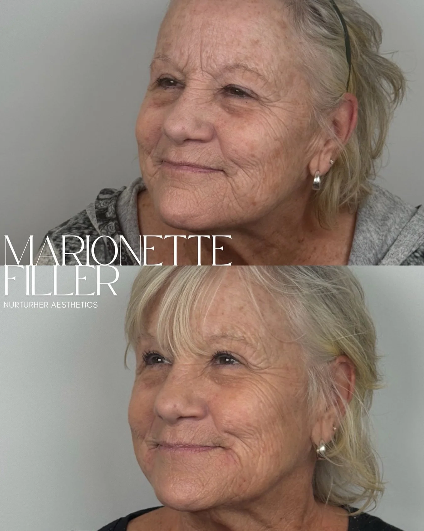 Restoration, not reinvention.

Marionette filler is about thoughtfully restoring support where the face has naturally changed over time. By treating the lower face with intention, we can soften the appearance of marionette lines and create a more bal