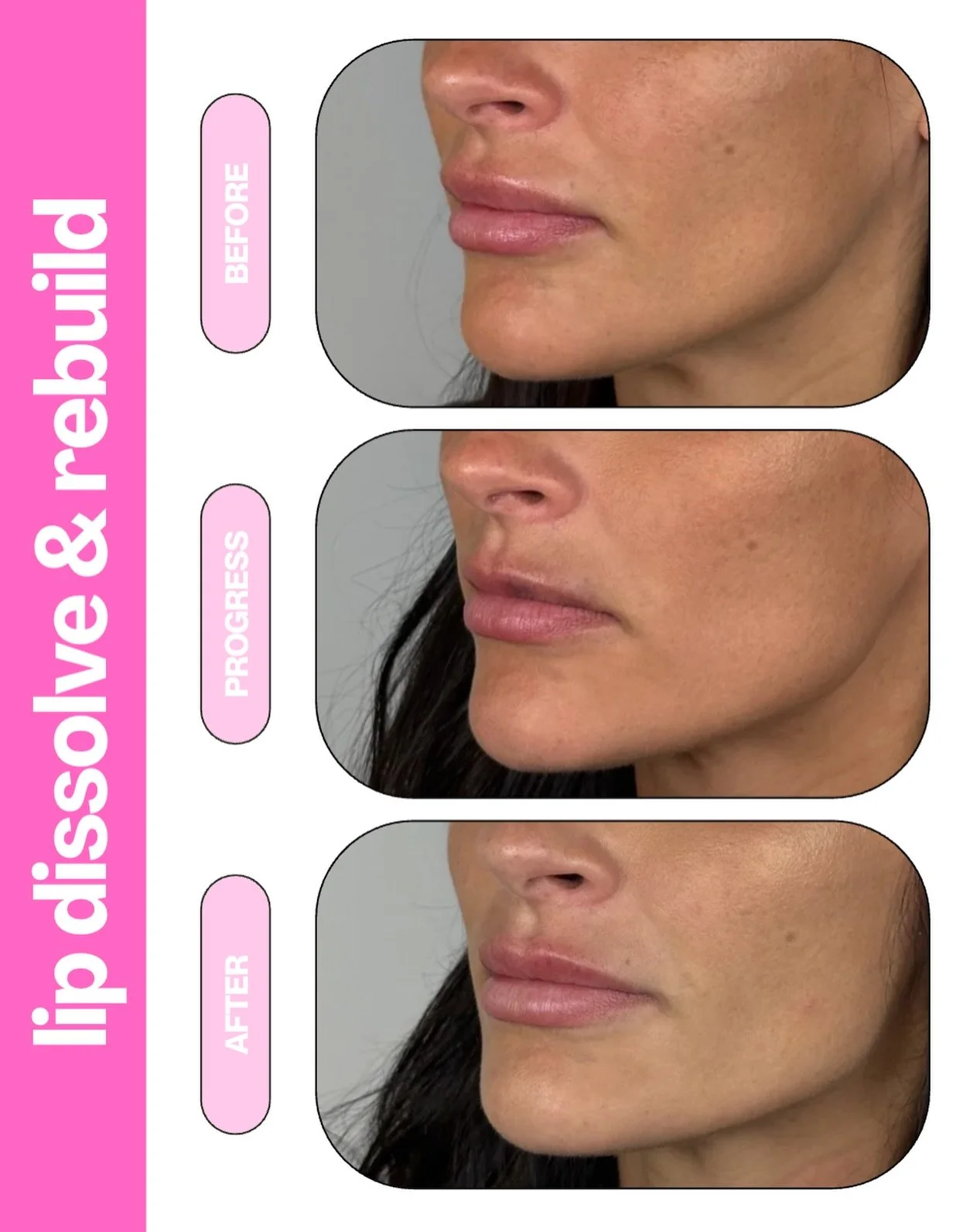A case for starting fresh.

This lip filler journey began with a dissolve, followed by a gradual rebuild to create a softer, more balanced result.

Rather than chasing volume, we focused on shape, proportion, and what made sense for her features. The