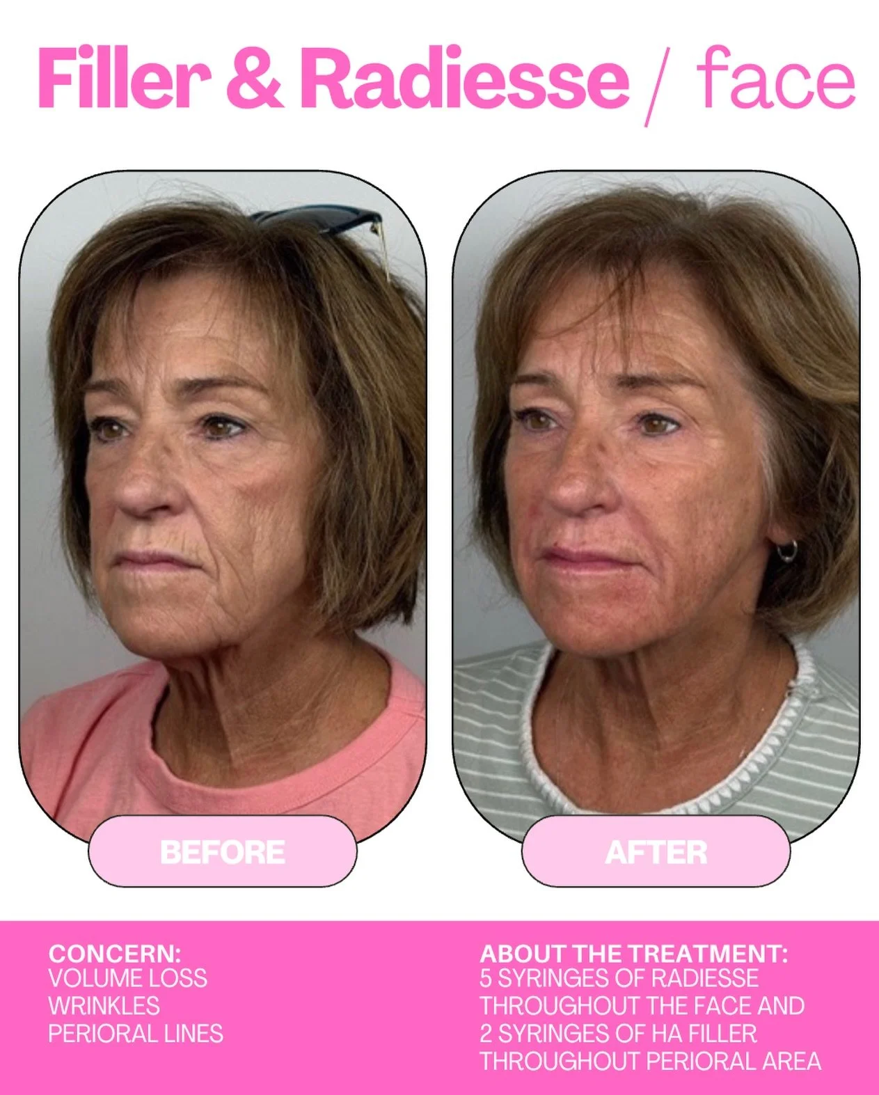 The details make the difference.

A little more support here. A softer transition there. An approach that considers the face as a whole.

For this patient, we paired Radiesse throughout the face with hyaluronic acid filler around the mouth, addressin