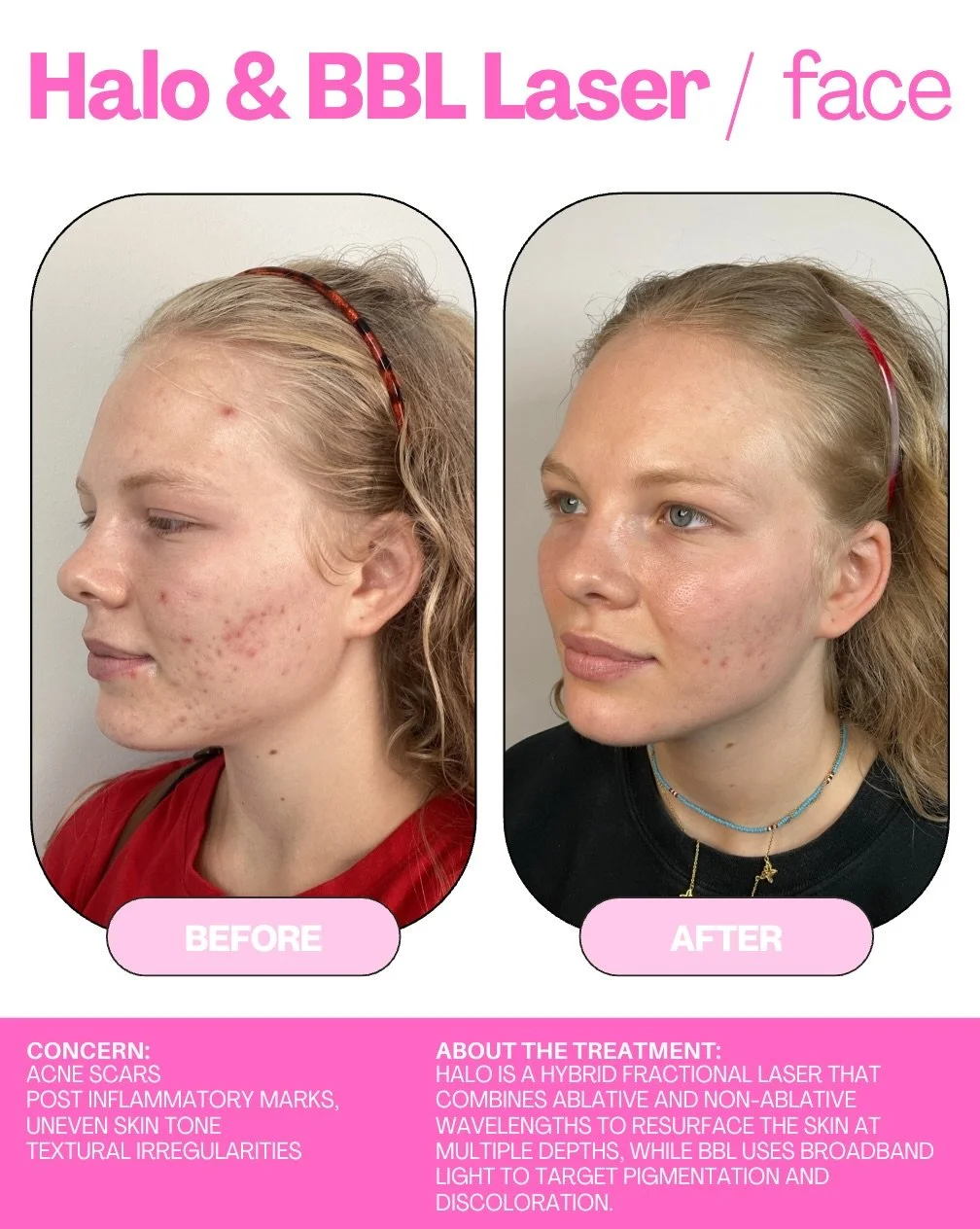 The best part of a skin journey? Seeing your progress over time 🤍

The goal is never perfection. It&rsquo;s feeling good in your skin, noticing the changes you&rsquo;ve worked toward, and feeling confident in the way you look.

Every skin journey is