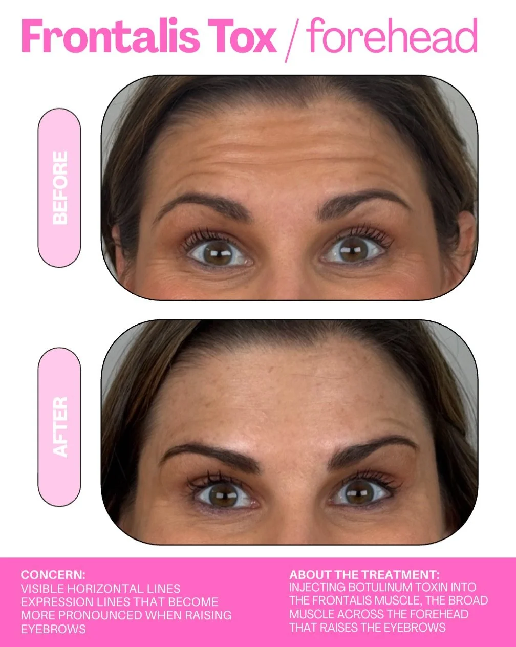 Less visible lines, smoother skin, and results that speak for themselves.

Frontalis tox softens horizontal forehead lines by relaxing the muscle responsible for raising your brows. The key is precise placement that respects your natural anatomy and 