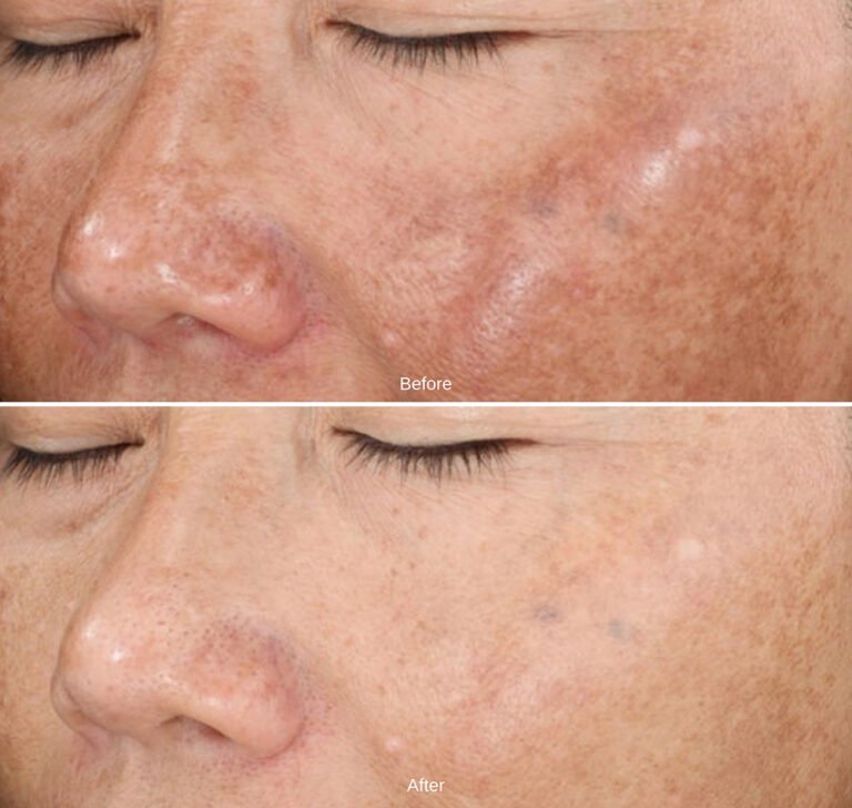 Elevating Your Experience: New Treatments at Elite Laser &amp; Beauty