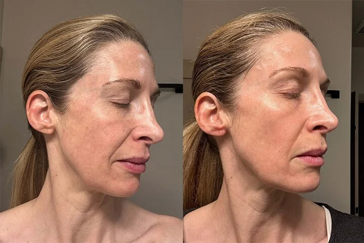 Chemical-Peels.jpg