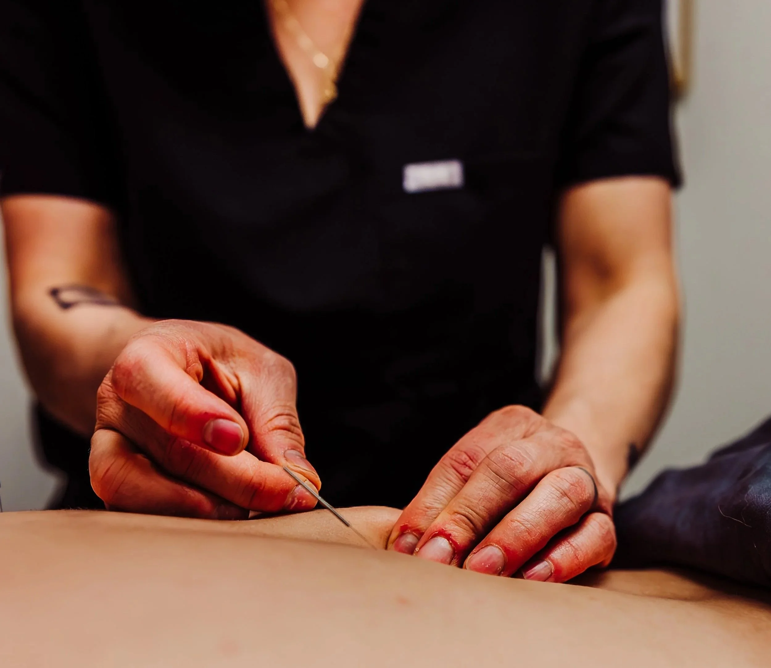 Acupuncture for back pain