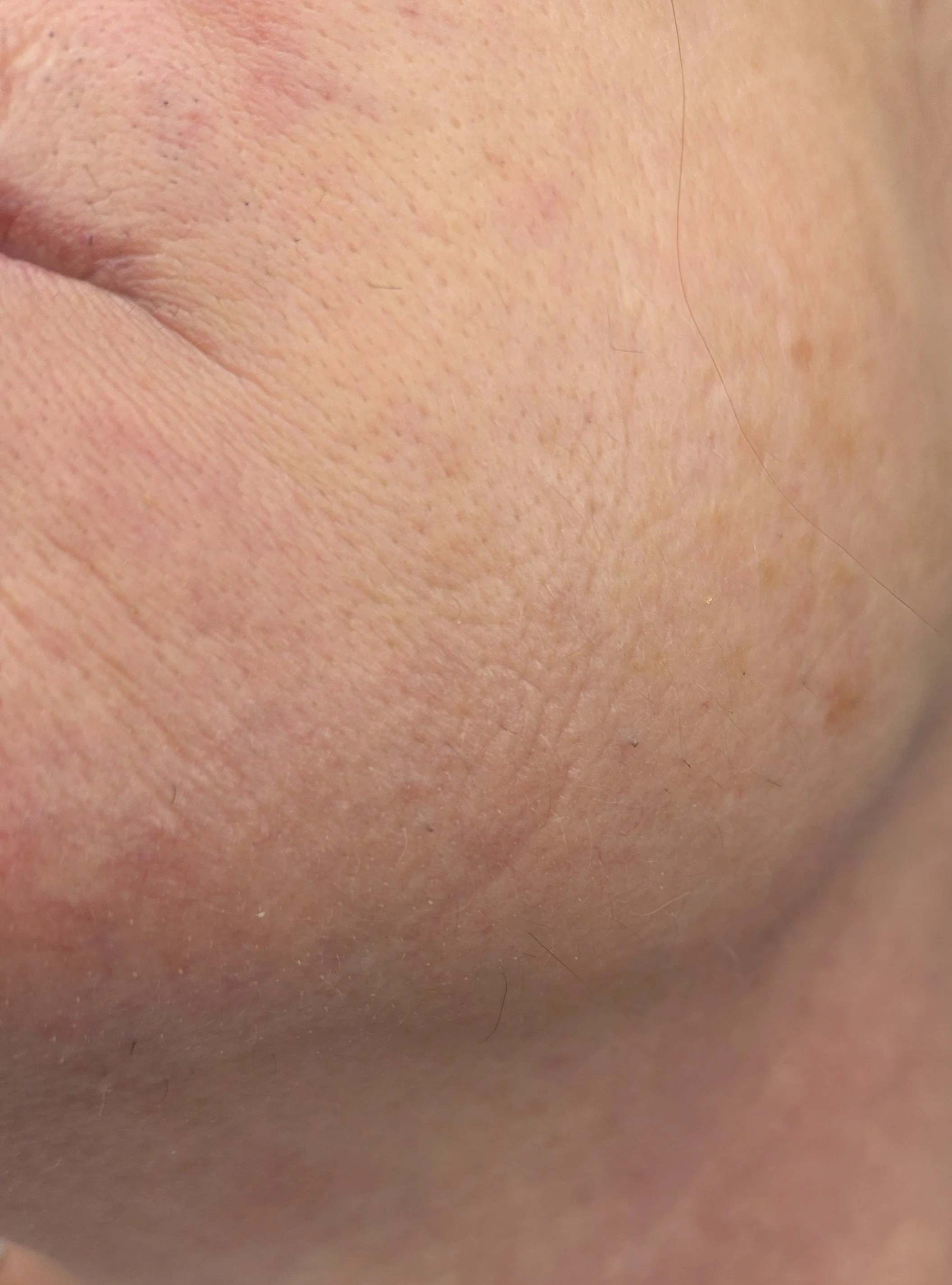 After 1 Treatment